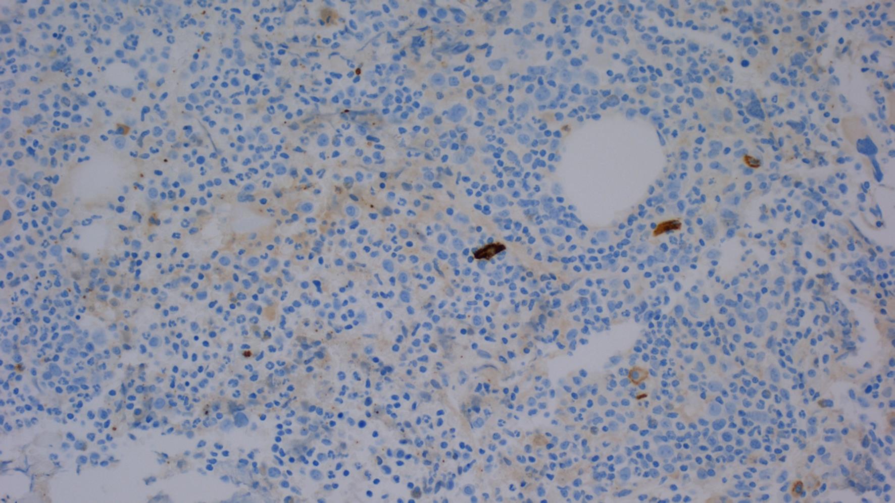 CD56 is not expressed in the T-large granular lymphocytic leukemia (T-LGLL) lymphocytes in the bone marrow (Immunoperoxidase stain, original magnification 400×).