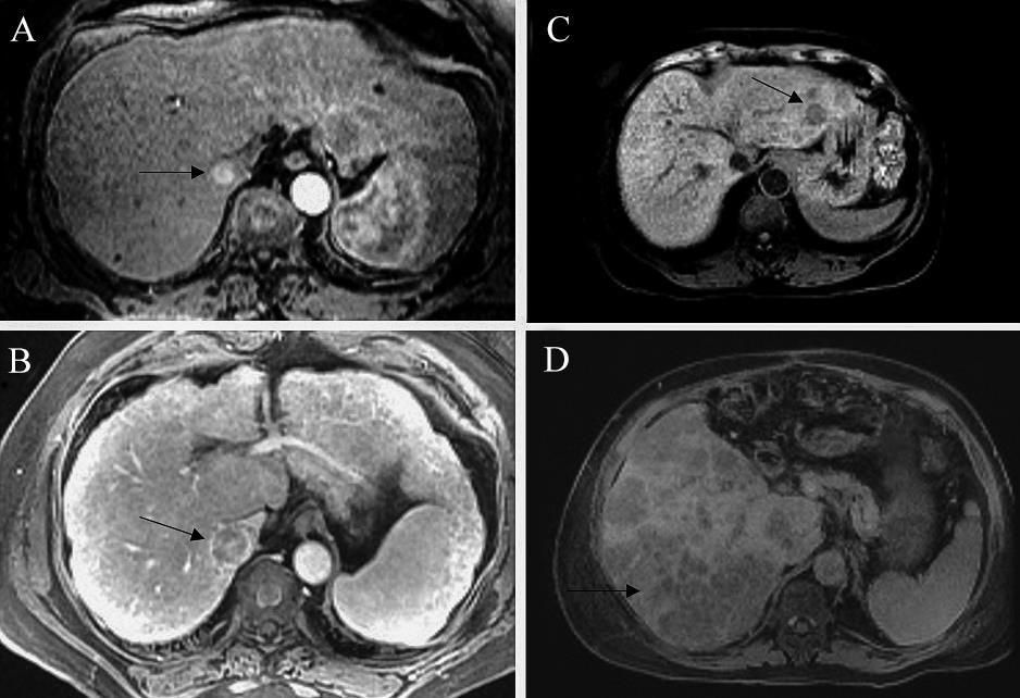 Radiologic images of hepatocellular carcinoma (HCC).