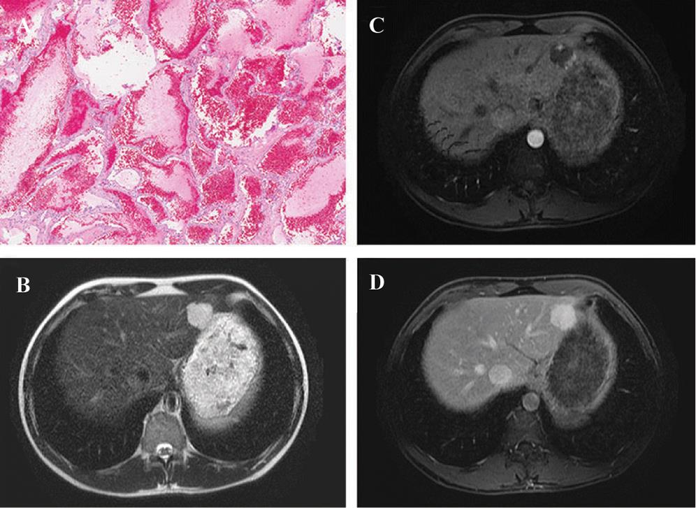 Hepatic hemangioma.