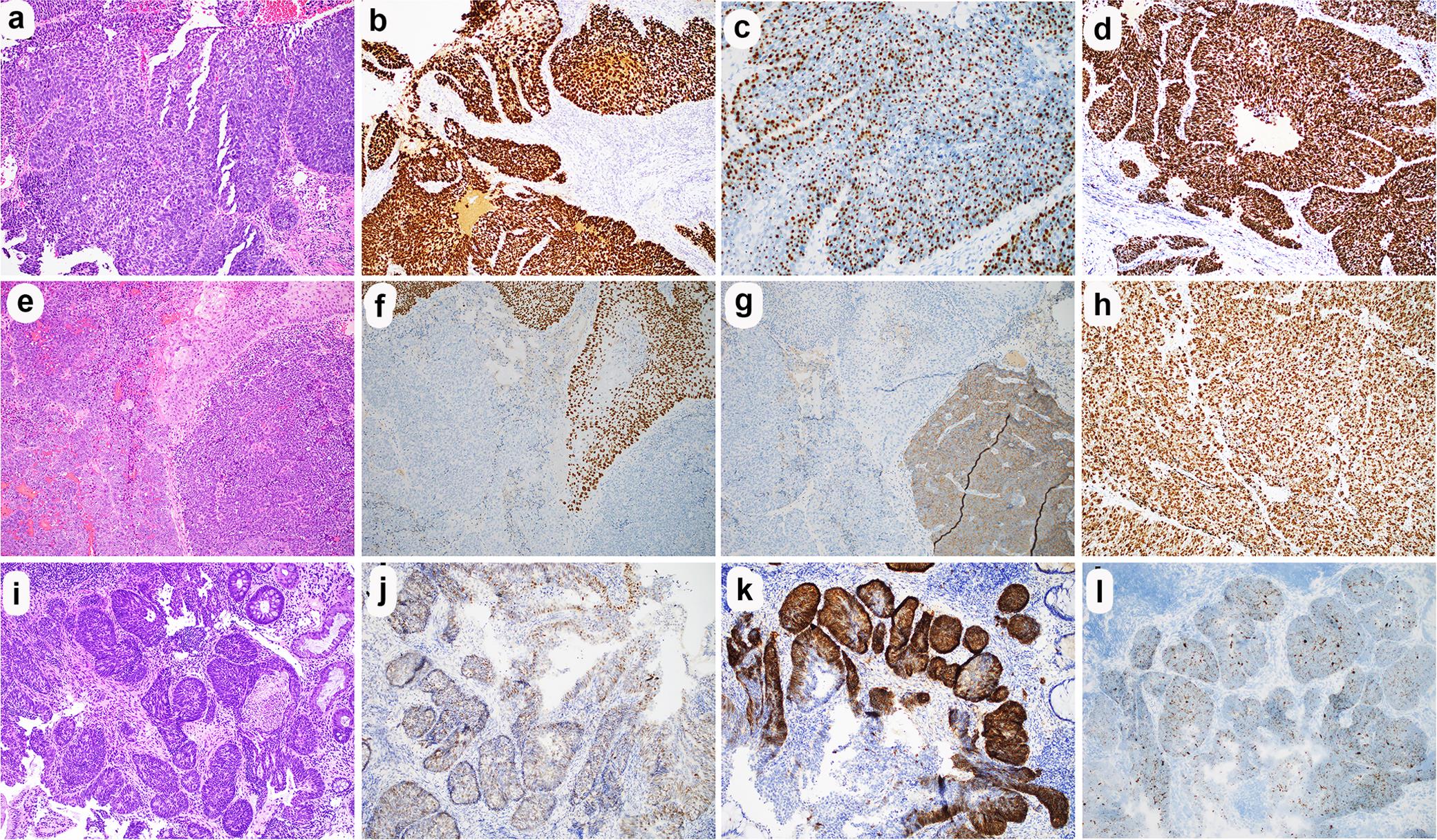 Comparisons between anal squamous cell carcinoma (SqCC) and neuroendocrine carcinoma (NEC).