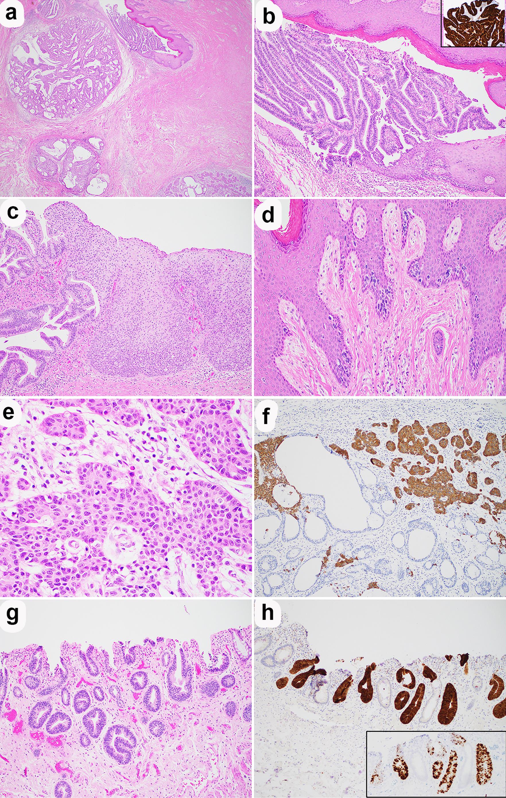 A unique case of HPV-associated adenocarcinoma in the anal canal.
