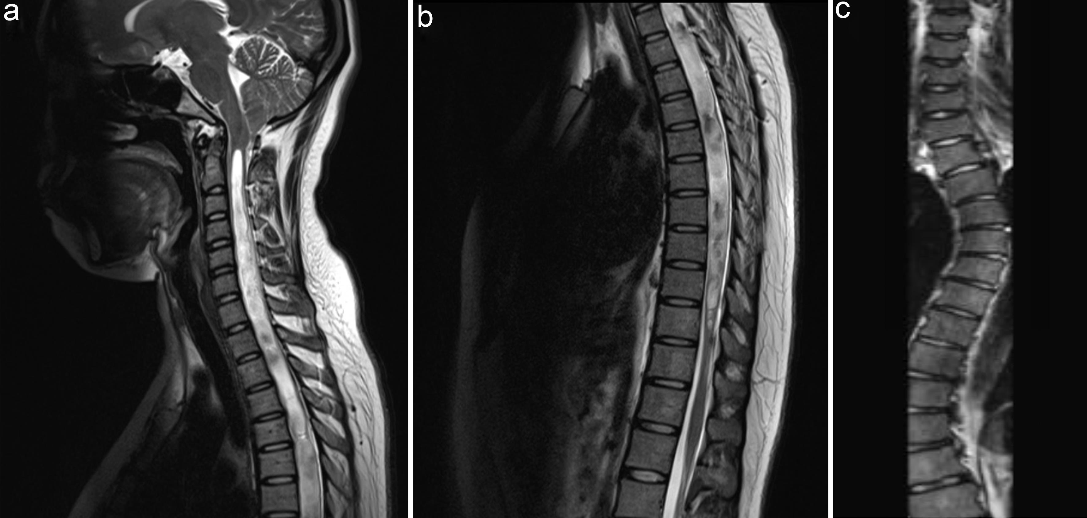 Typical magnetic resonance imaging (MRI) findings of Chiari malformation type I.