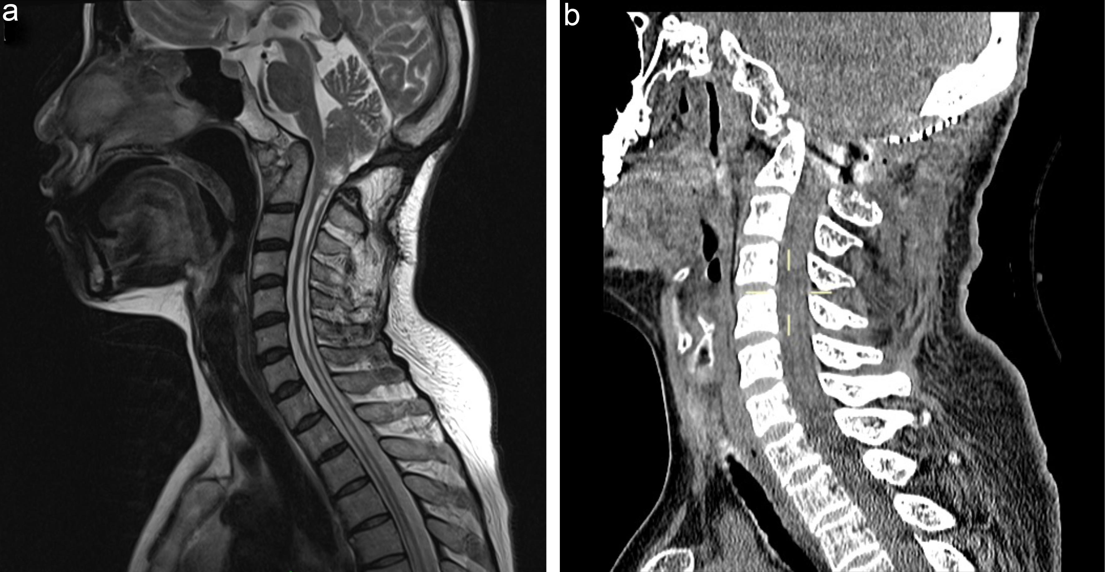 Revision surgery for extended bony removal of posterior fossa decompression.