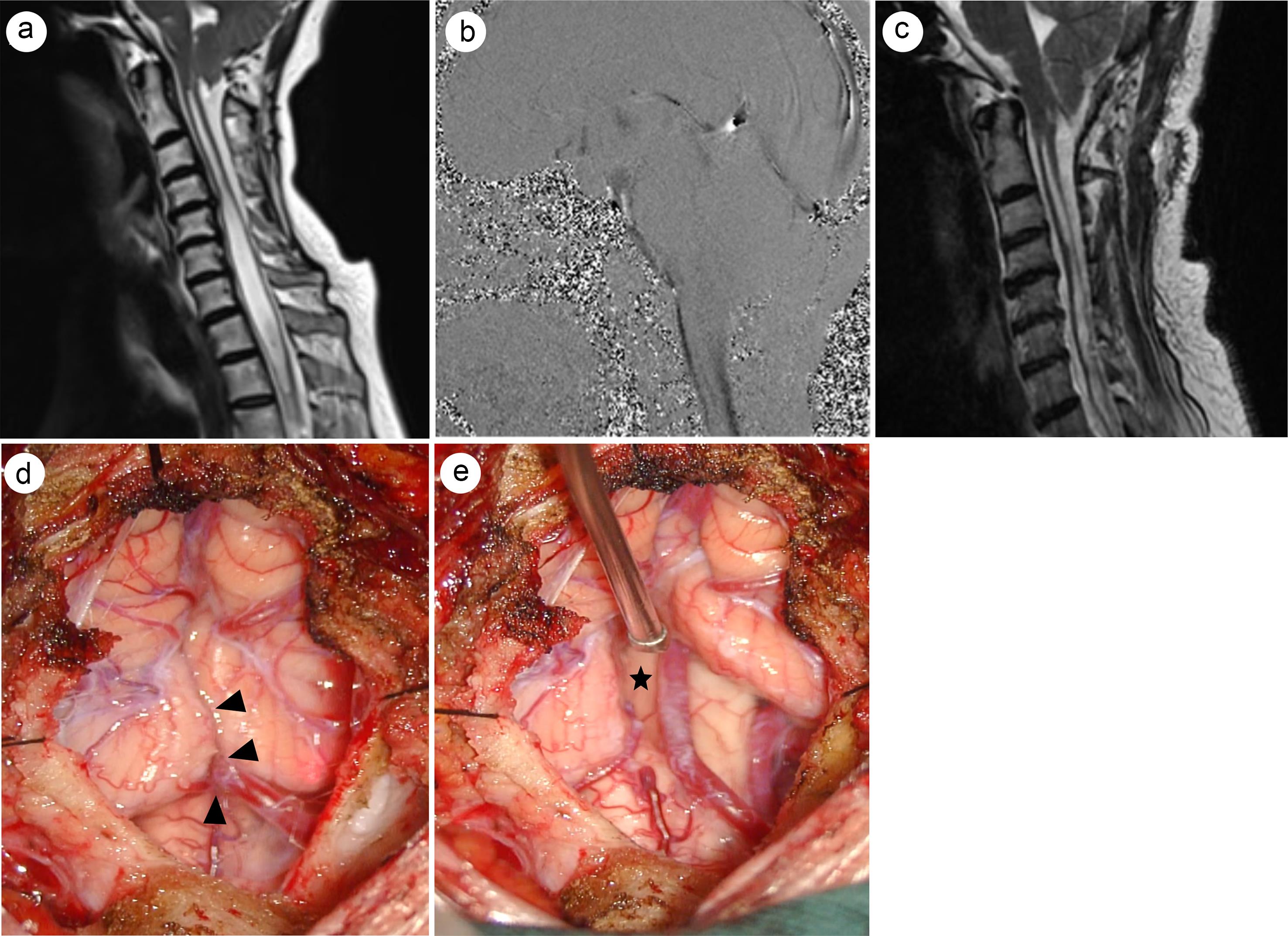 Representative case for posterior fossa decompression with duraplasty.