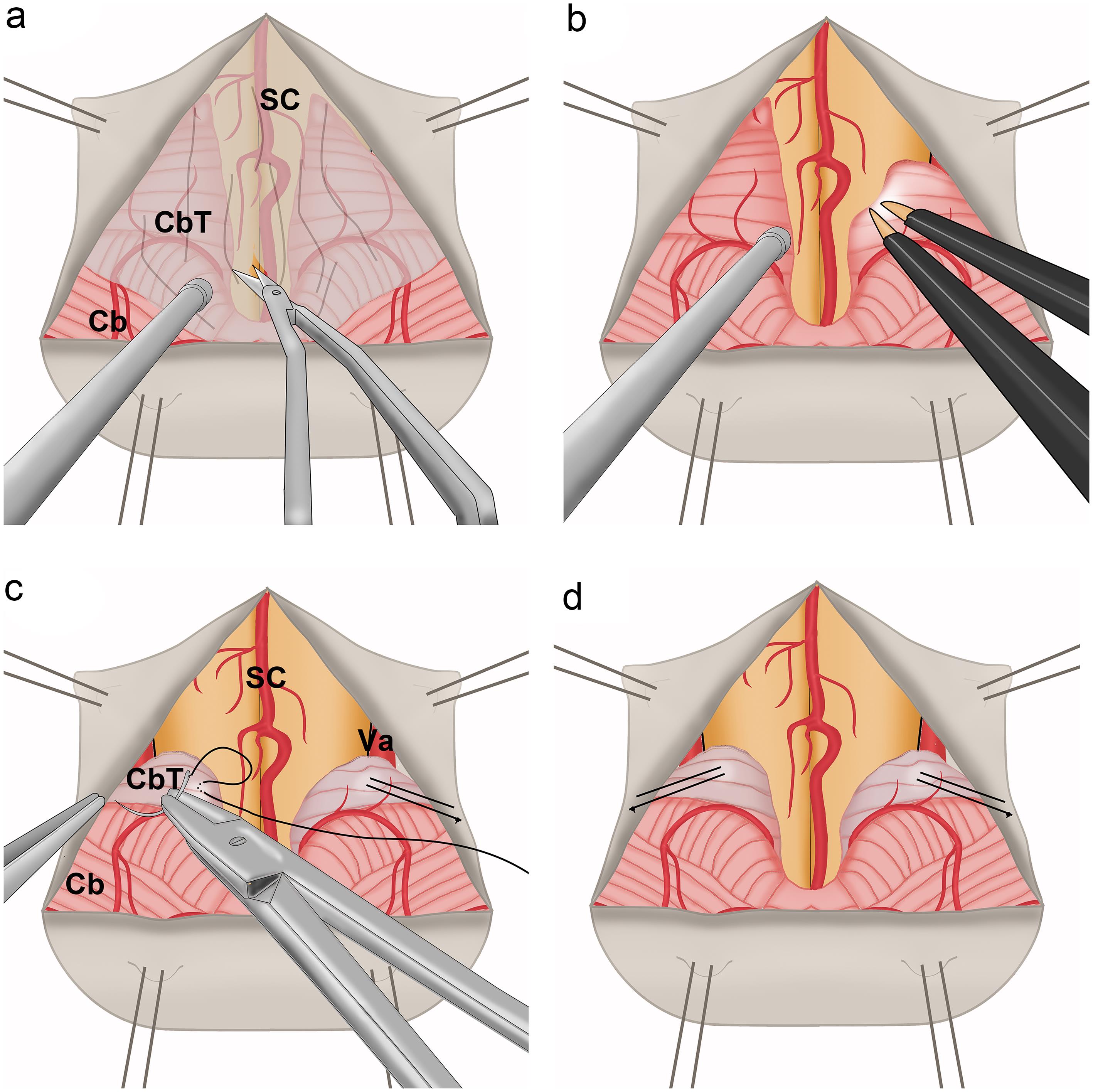 Illustration of surgical procedures for cerebellar tonsil suspension (CTS) during posterior fossa decompression with duraplasty (PFDD).