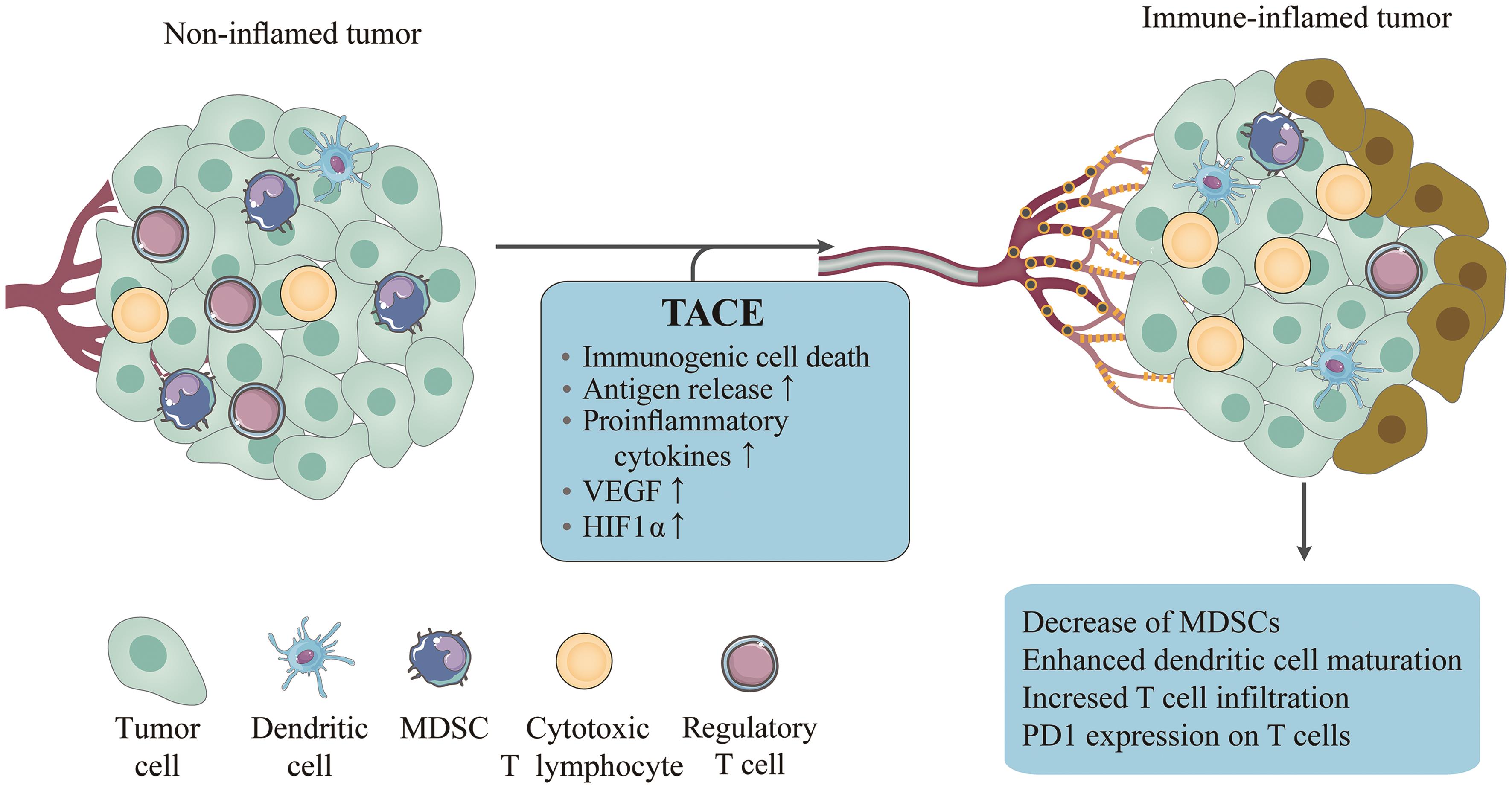 Treatment Of Metastatic Hepatocellular Carcinoma