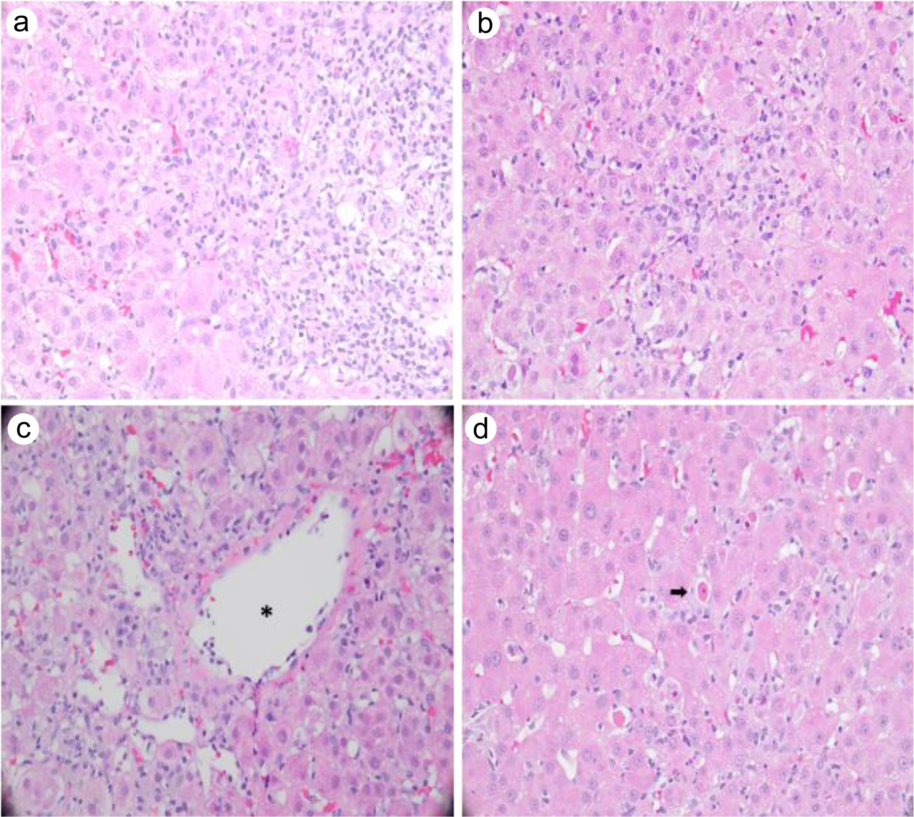 Histological morphological features of liver biopsy.