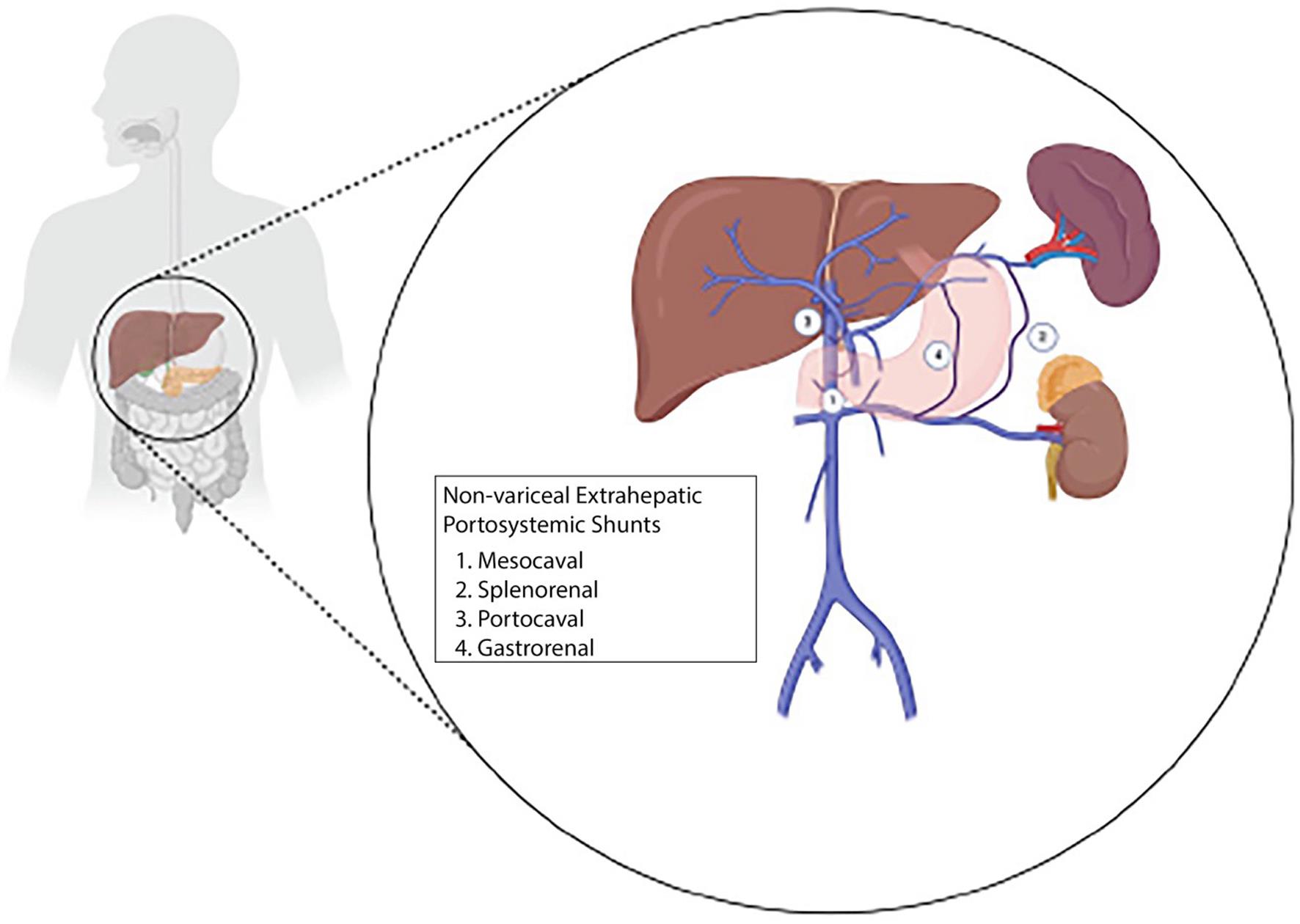 Schematic diagram of prevalent NVEPS.