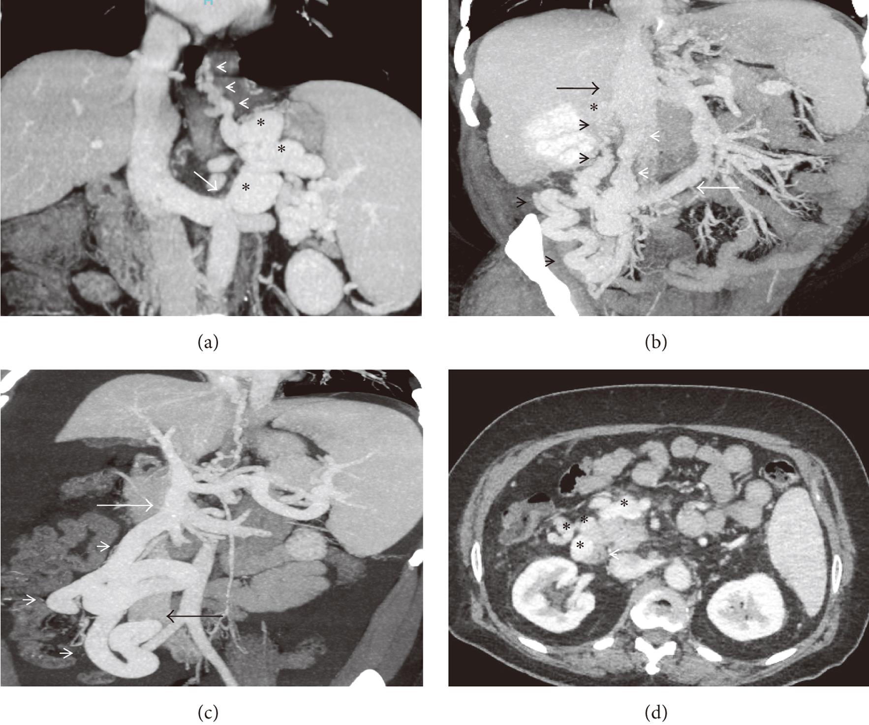 Maximum-intensity-projection, contrast-enhanced CT imaging of various NVEPS.