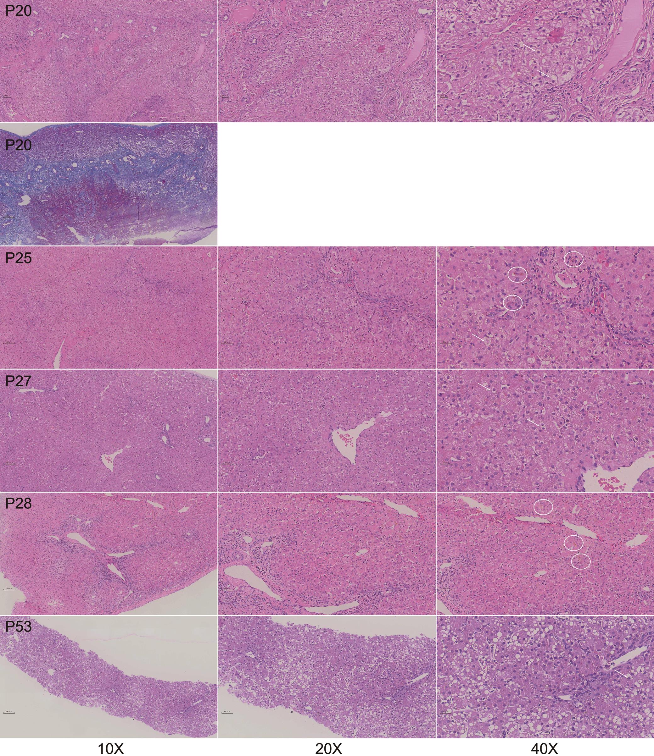 Histopathologic findings in the livers of five patients.