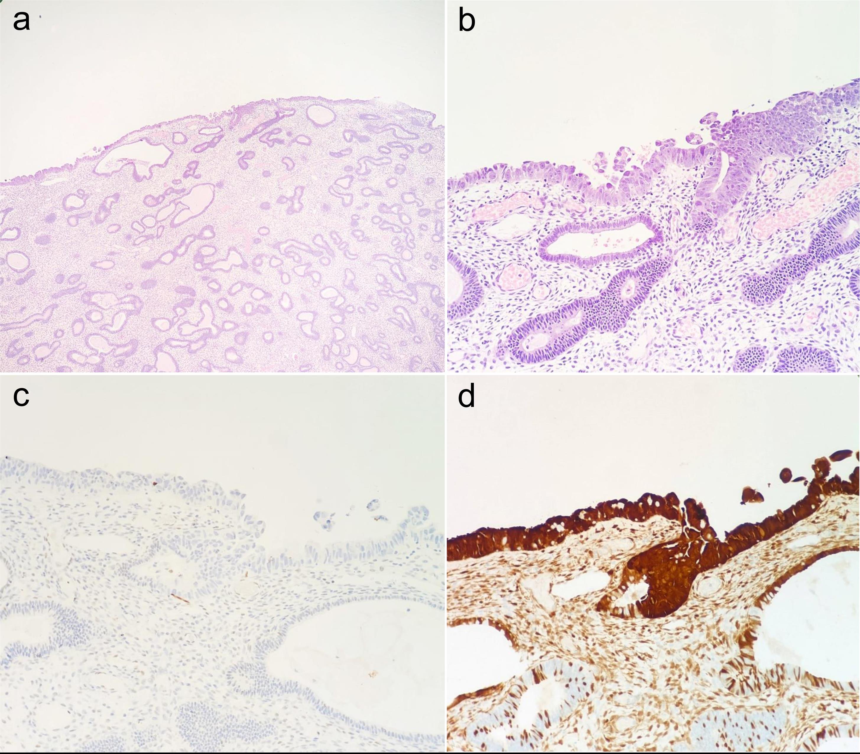 A case of serous endometrial intraepithelial carcinoma (SEIC) on the surface of an endometrial polyp.