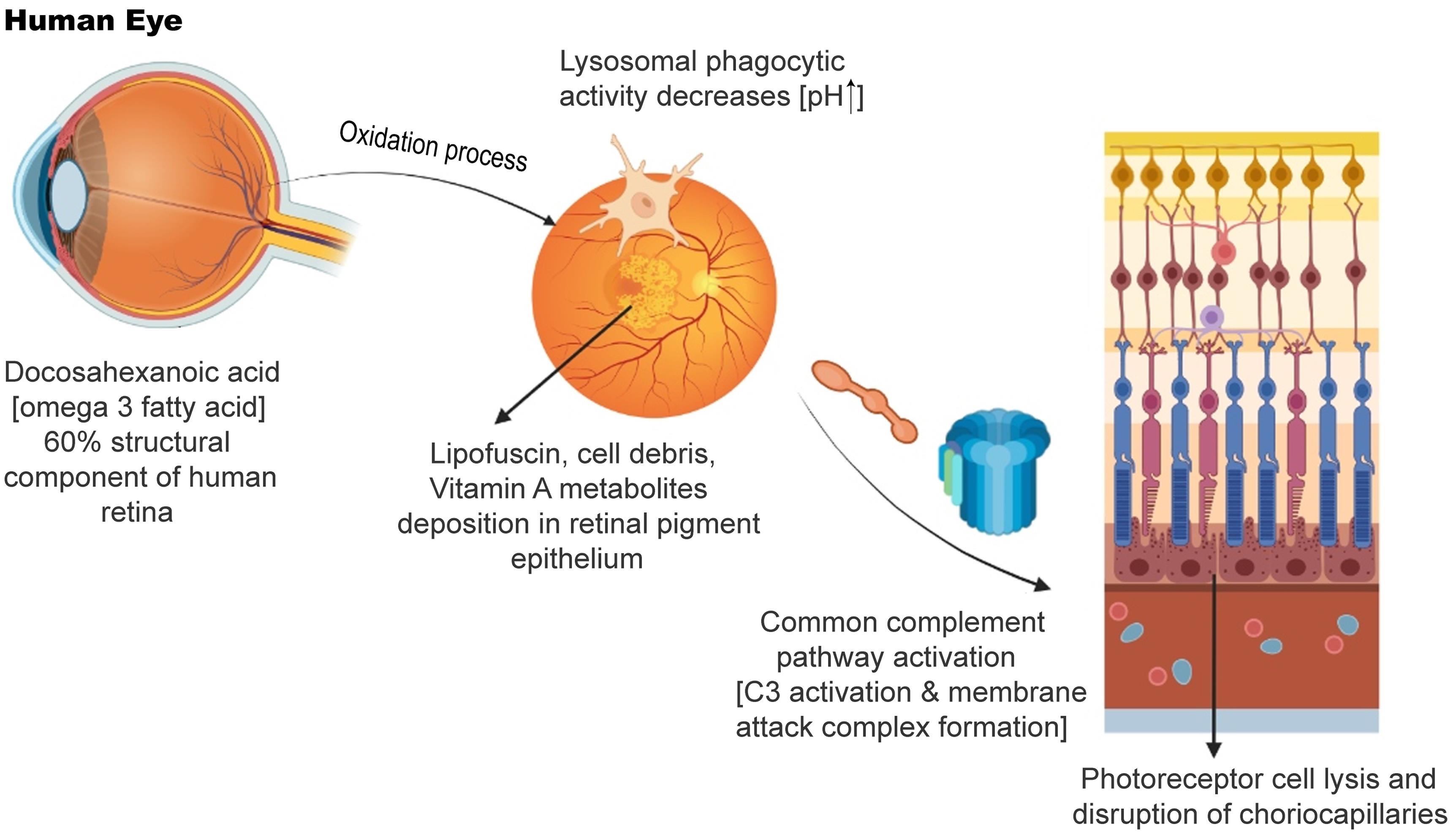 Pathogenesis of dry age related macular degeneration and geographical atrophy.