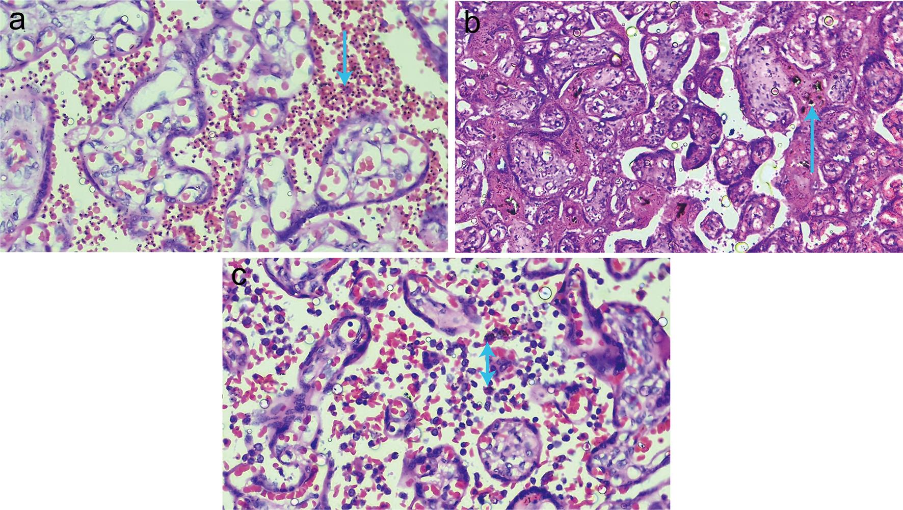 Histological slides showing different types of placental malaria.