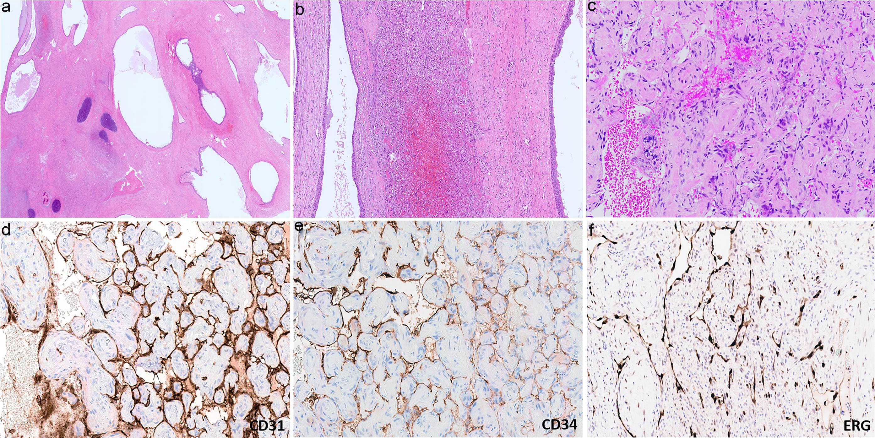 Hematoxylin and eosin-stained section of mediastinal mass shows mature cystic teratoma (a). Spindle and epithelioid cells proliferate and form irregular vascular channels with intraluminal budding and papillary-like projections (b, c). The atypical cells are positive for CD31 (d), CD34 (e), and ERG (f), supporting the diagnosis of angiosarcoma.