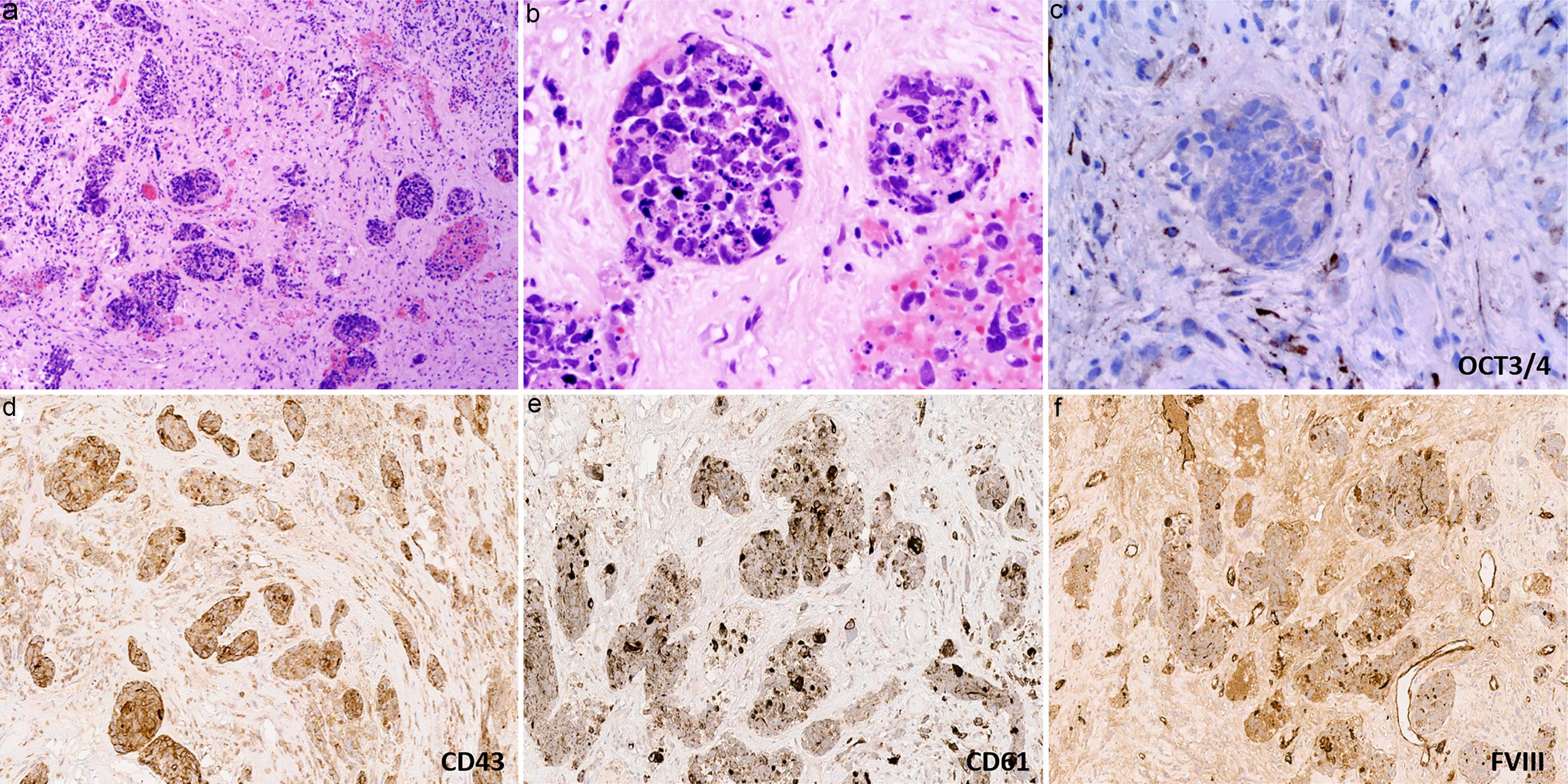 Hematoxylin and eosin-stained section of mediastinal mass shows small nests of highly atypical tumor cells with large, polymorphic, hyperchromatic nuclei, mixed with blood cells and fibrin (a, b). The atypical cells are negative for OCT3/4 (c) and positive for CD43 (d), CD61 (e), and Factor VIII (f), consistent with acute megakaryoblastic leukemia.