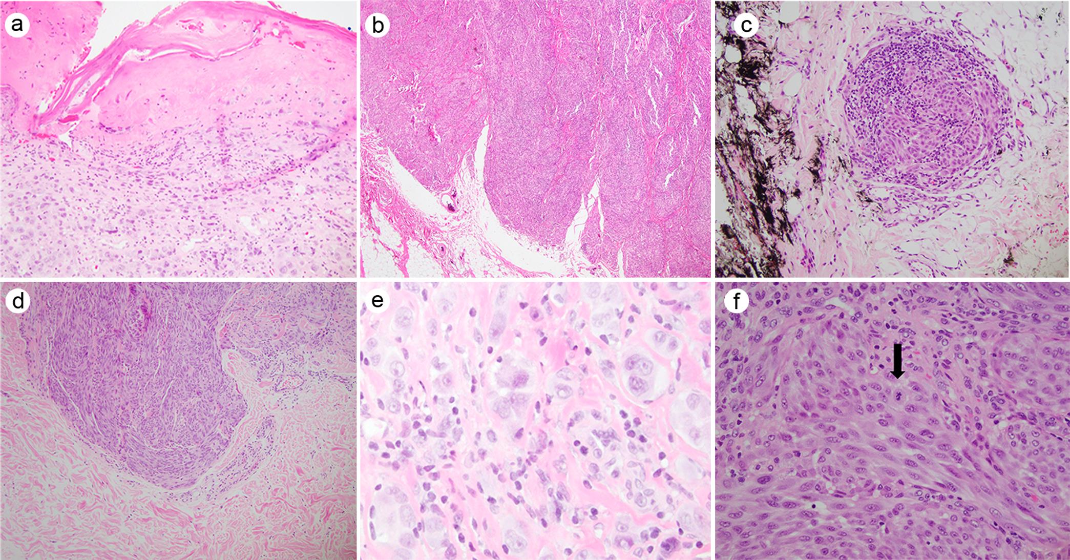 Features that support Spitz melanoma.