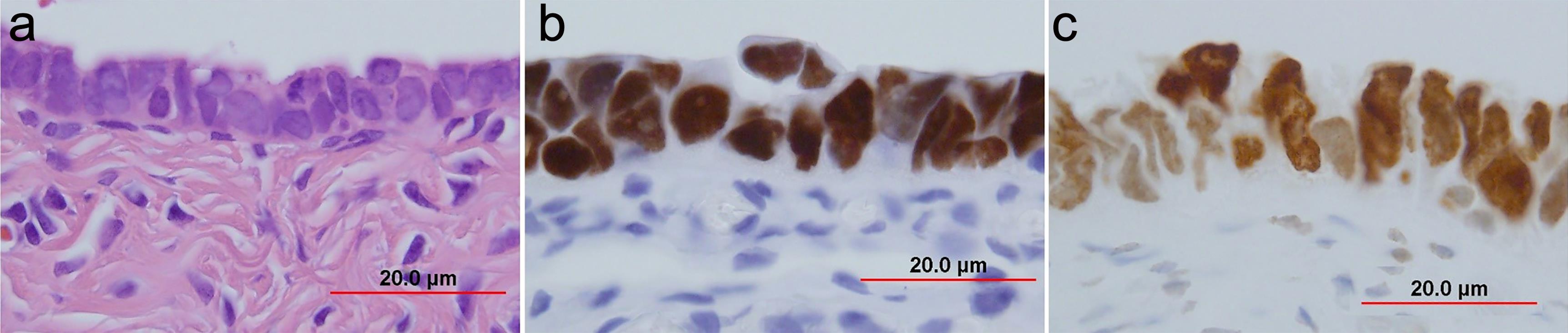 HMGA2 expression in serous tubal intraepithelial carcinoma (STIC).