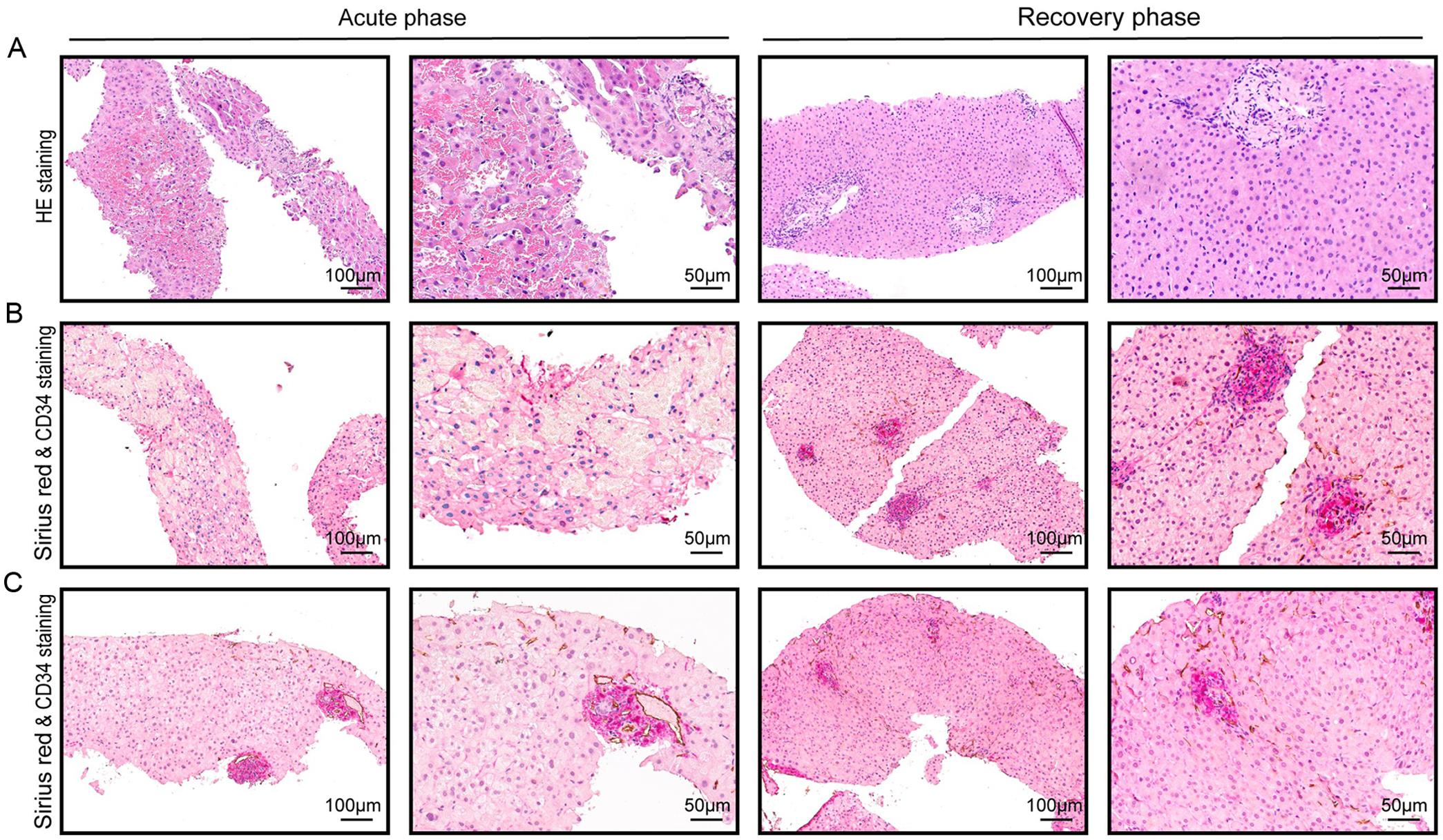 Representative histopathological images of patients with matched pathology in diagnostic liver biopsy and recovery liver biopsy.