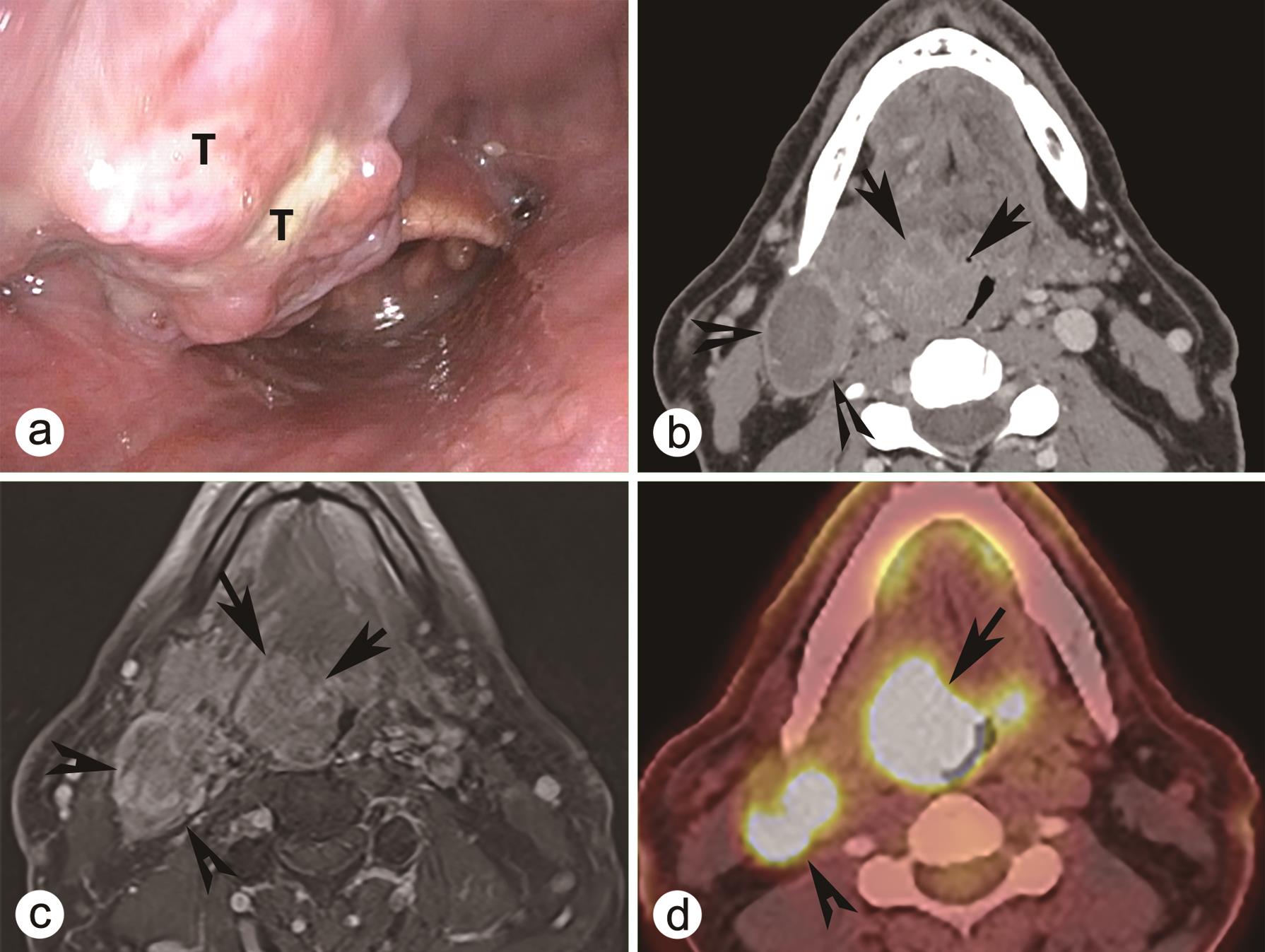 Oropharyngeal squamous cell carcinoma.