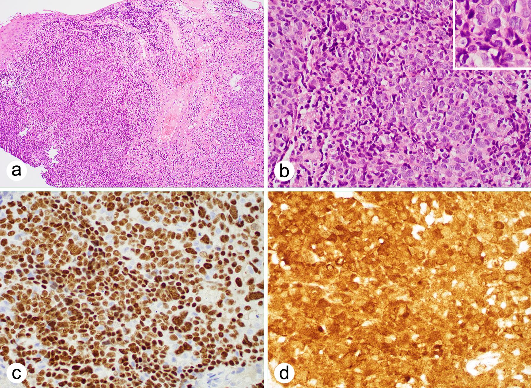 Oropharyngeal squamous cell carcinoma.