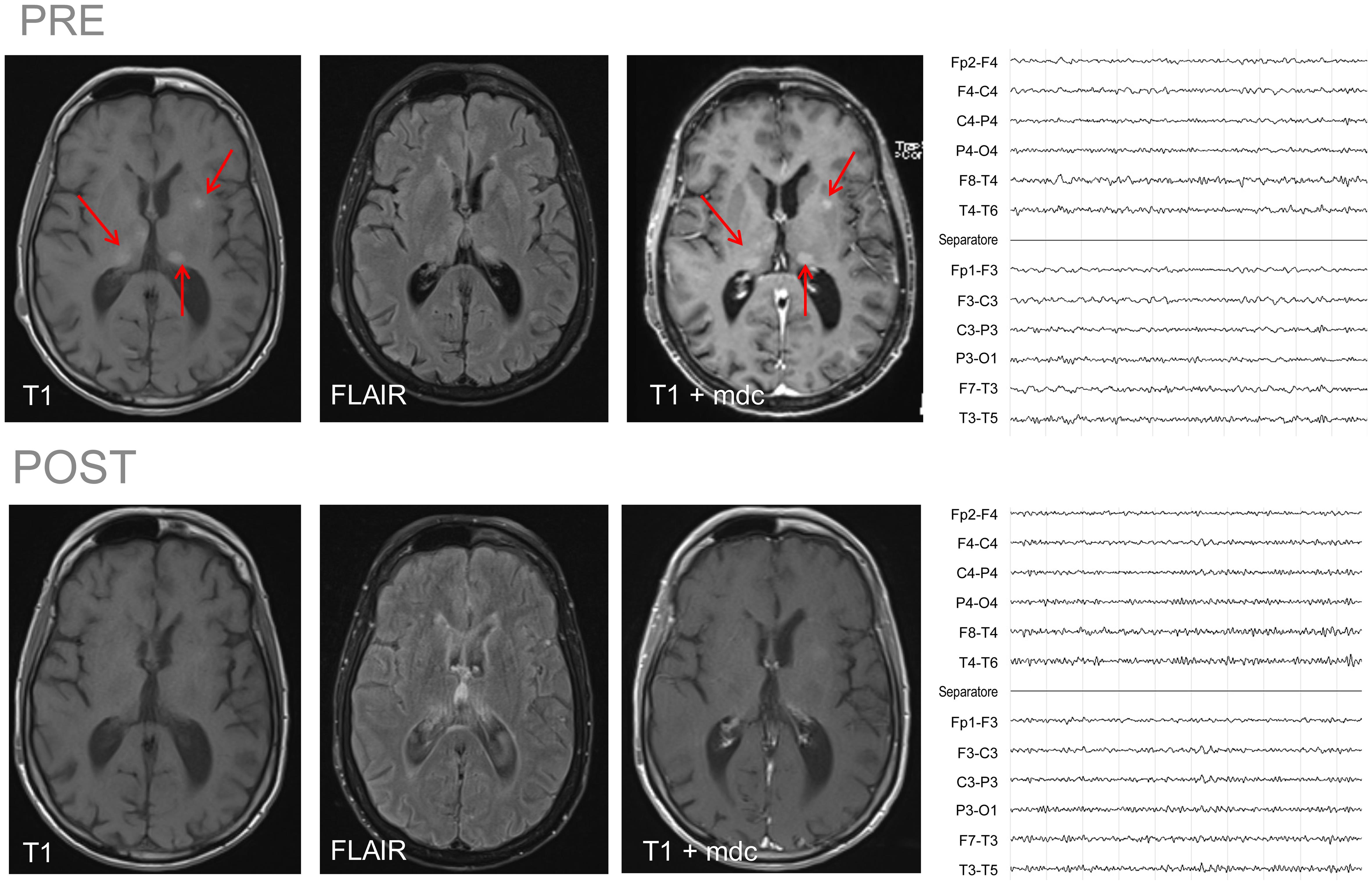 Brain magnetic resonance images with and without contrast medium (mdc) before (PRE; December 2020, upper photo) and after osimertinib therapy (POST; February 2022, lower photo), and electroencephalogram readings before (PRE; December 2020, upper photo) and after osimertinib therapy (POST; March 2022, lower photo).