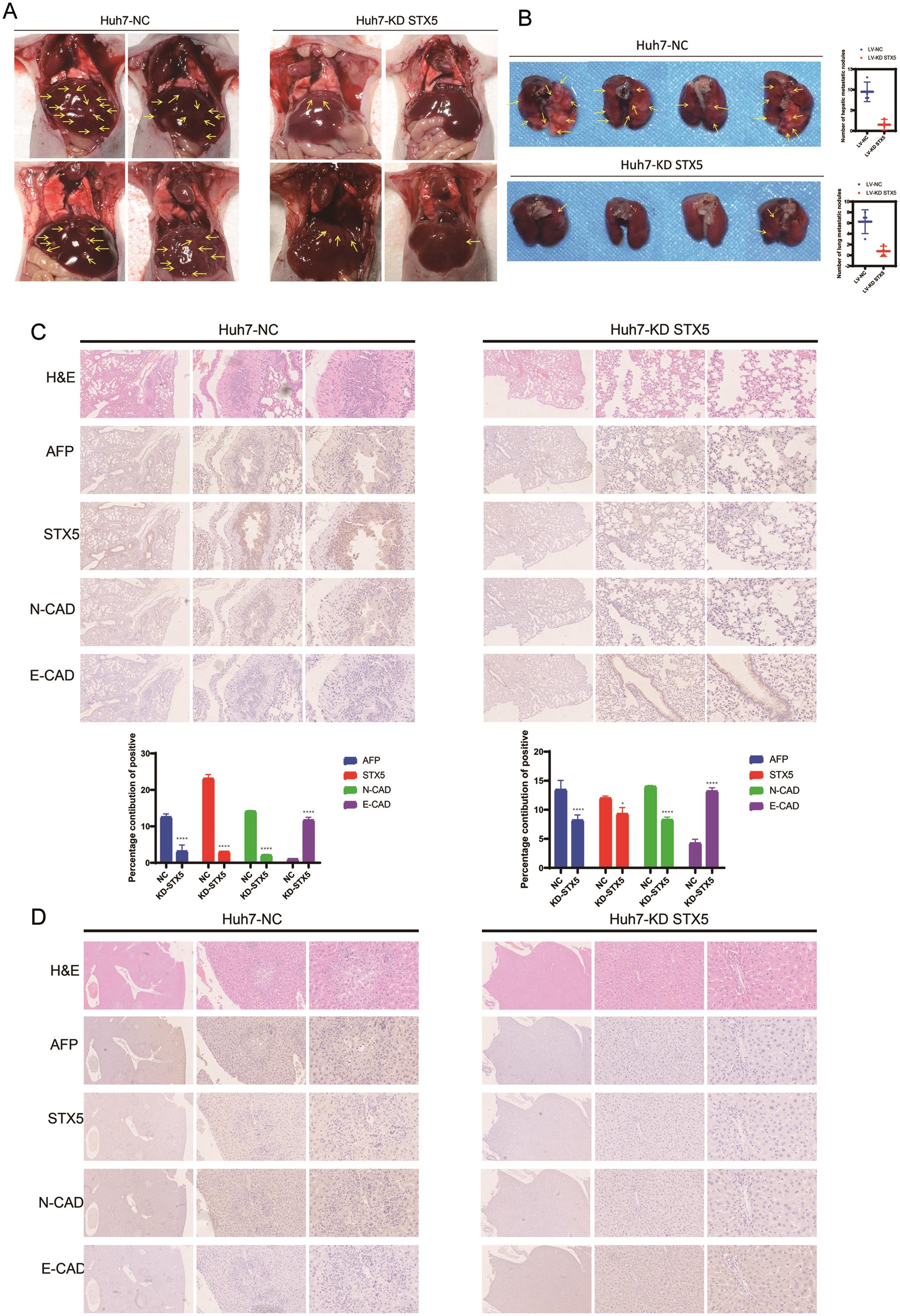 STX5 knockdown inhibits HCC cell metastasis <italic>in vivo</italic>.