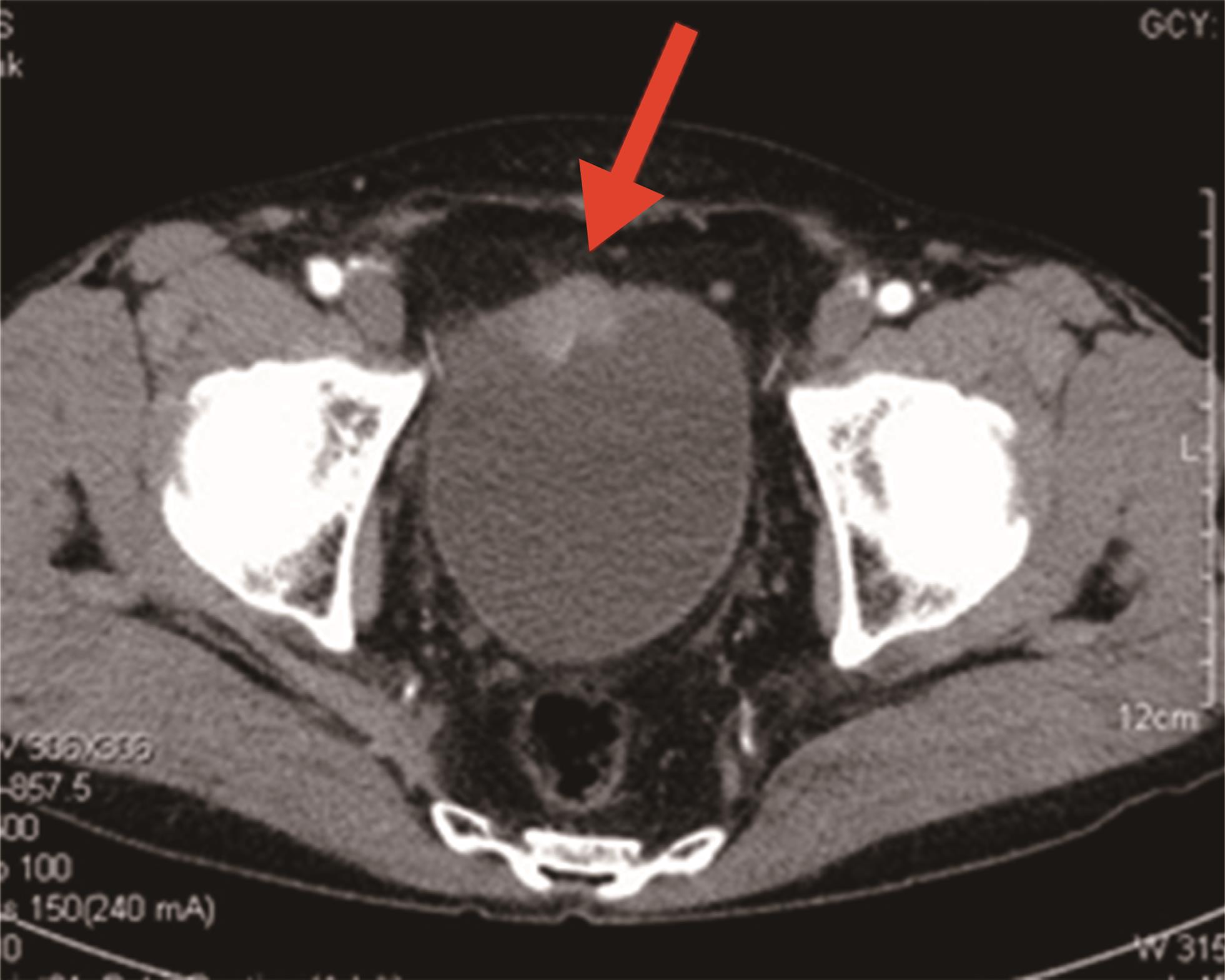 The typical CT image showed an enhanced solid mass in the anterior wall of the bladder dome.