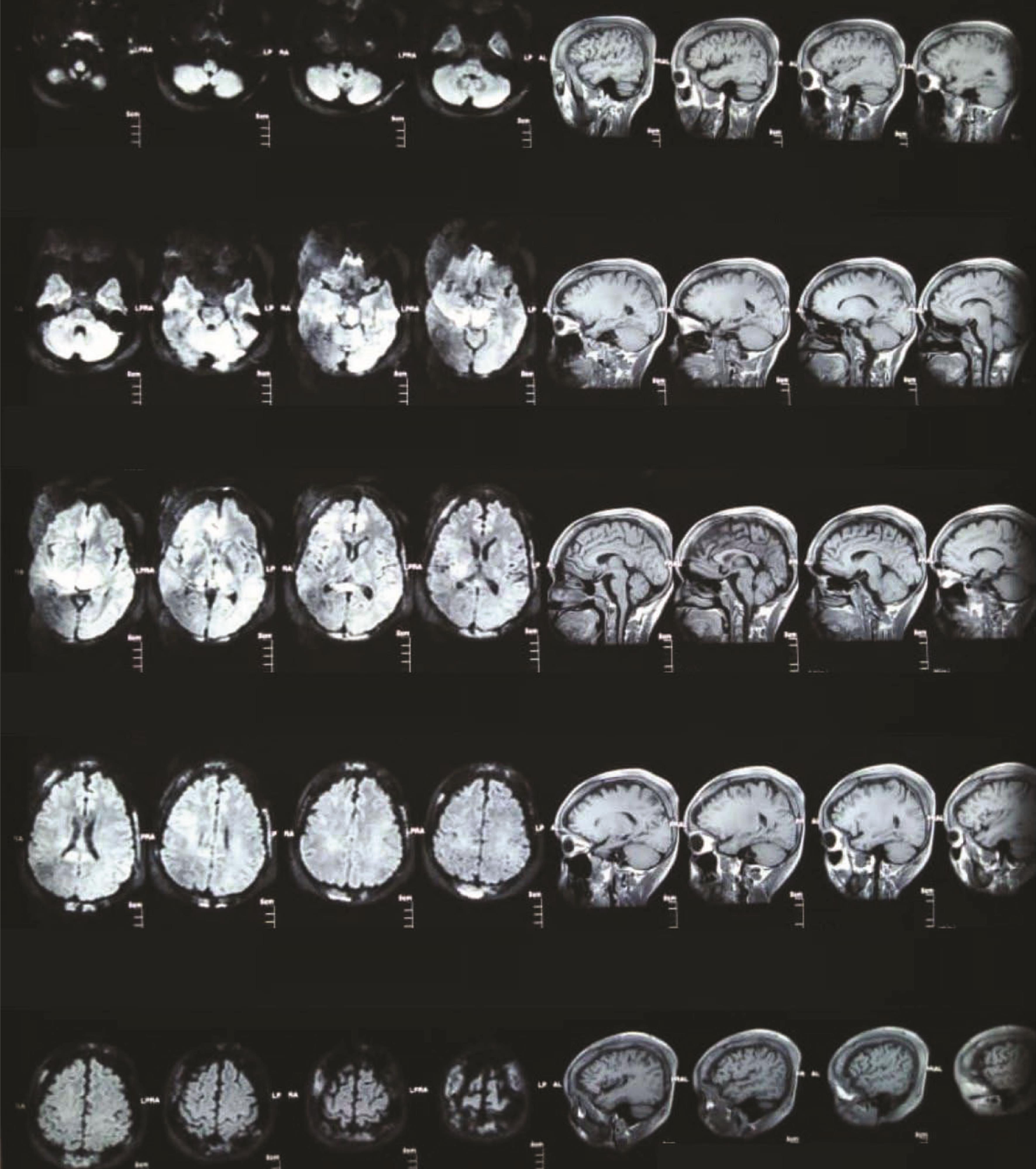 Brain magnetic resonance imaging scans of the patient, indicating left maxillary polypoid sinusitis and diploic space marrow signal changes consistent with known disease.