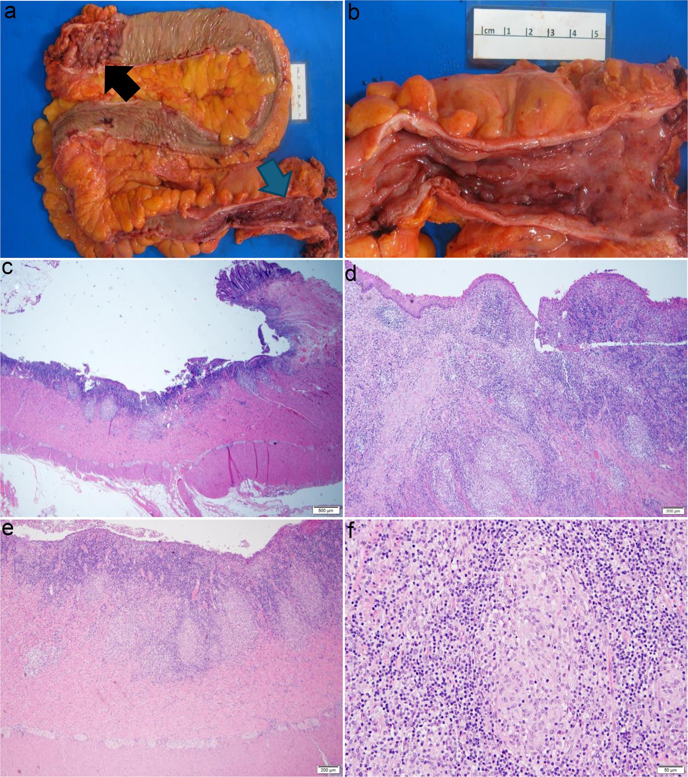 Gross and histopathologic features in Hermansky-Pudlak syndrome (HPS) proctocolectomy specimen.