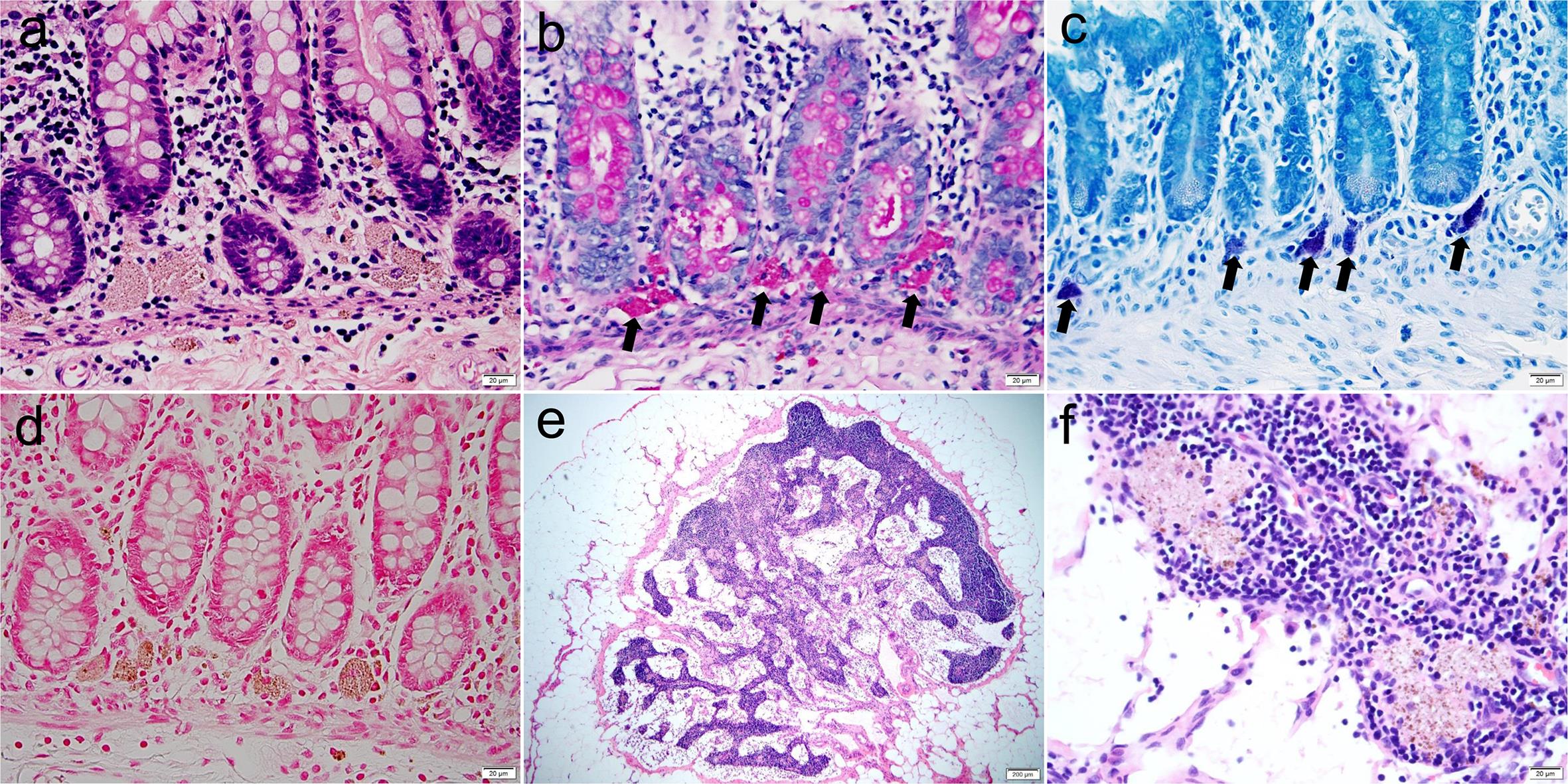 Pigment-laden histiocytes in proctocolectomy specimen.