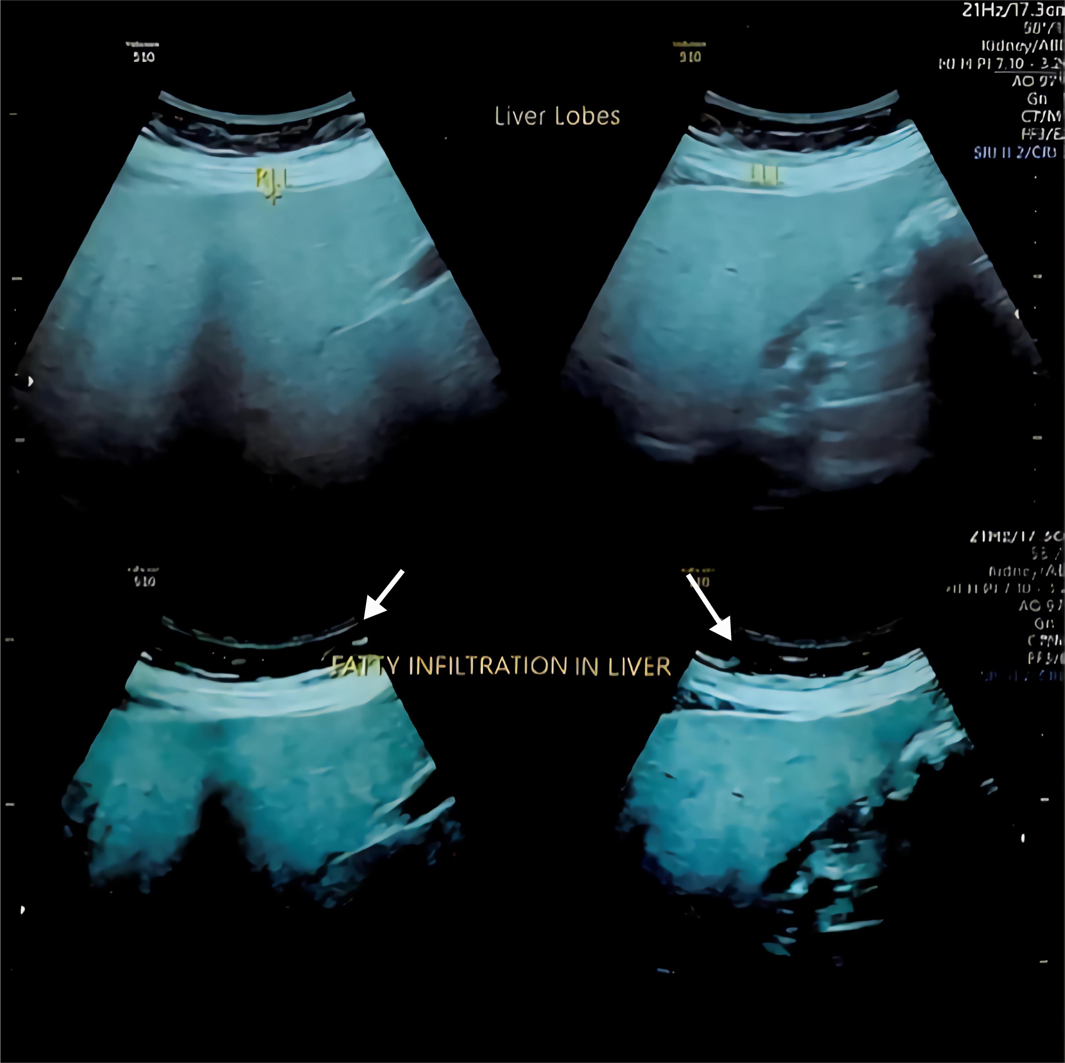 Ultrasound showing fatty infiltration in the liver.