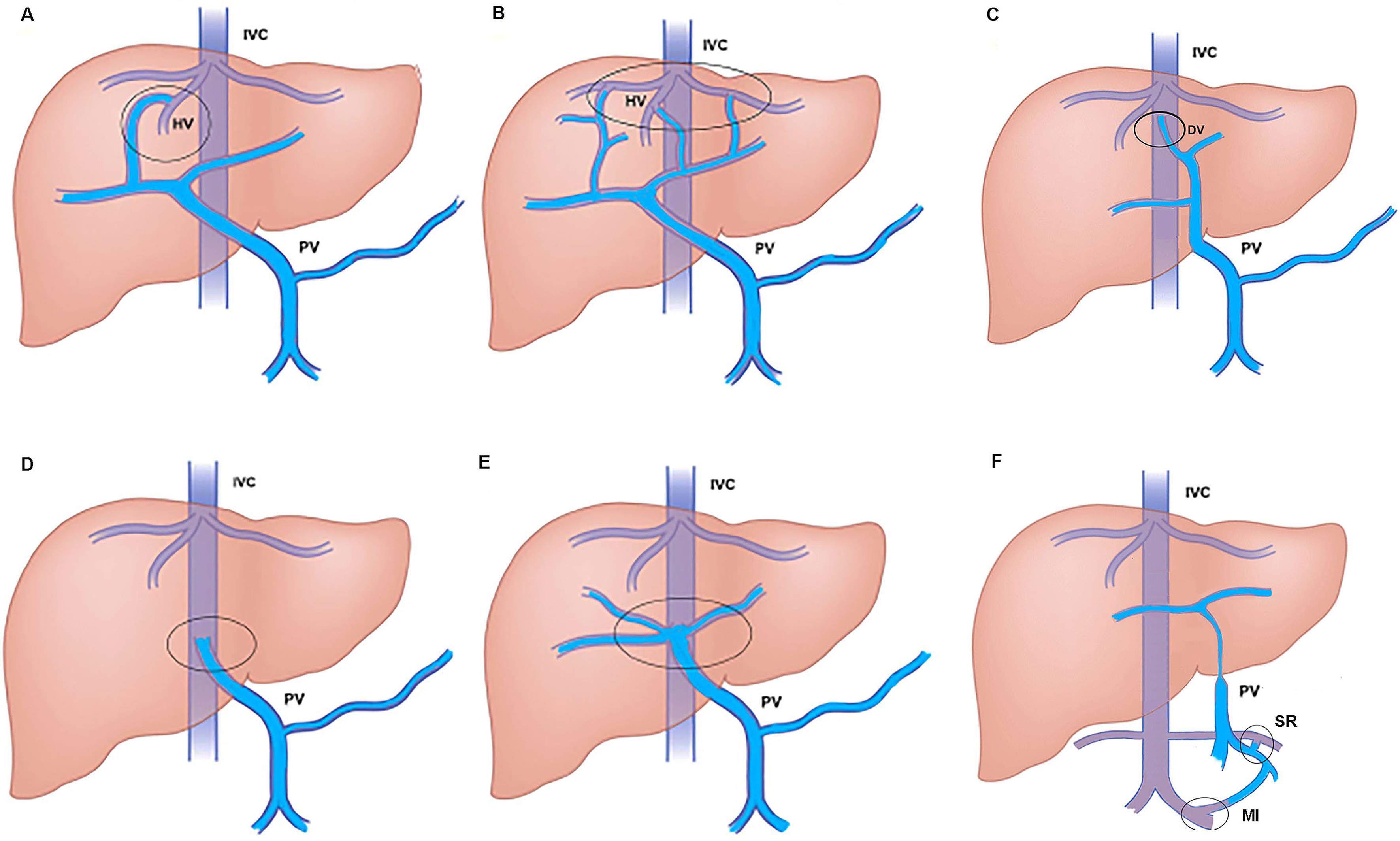 Schematic diagrams of congenital portosystemic shunts illustrating the main anatomical subtypes.