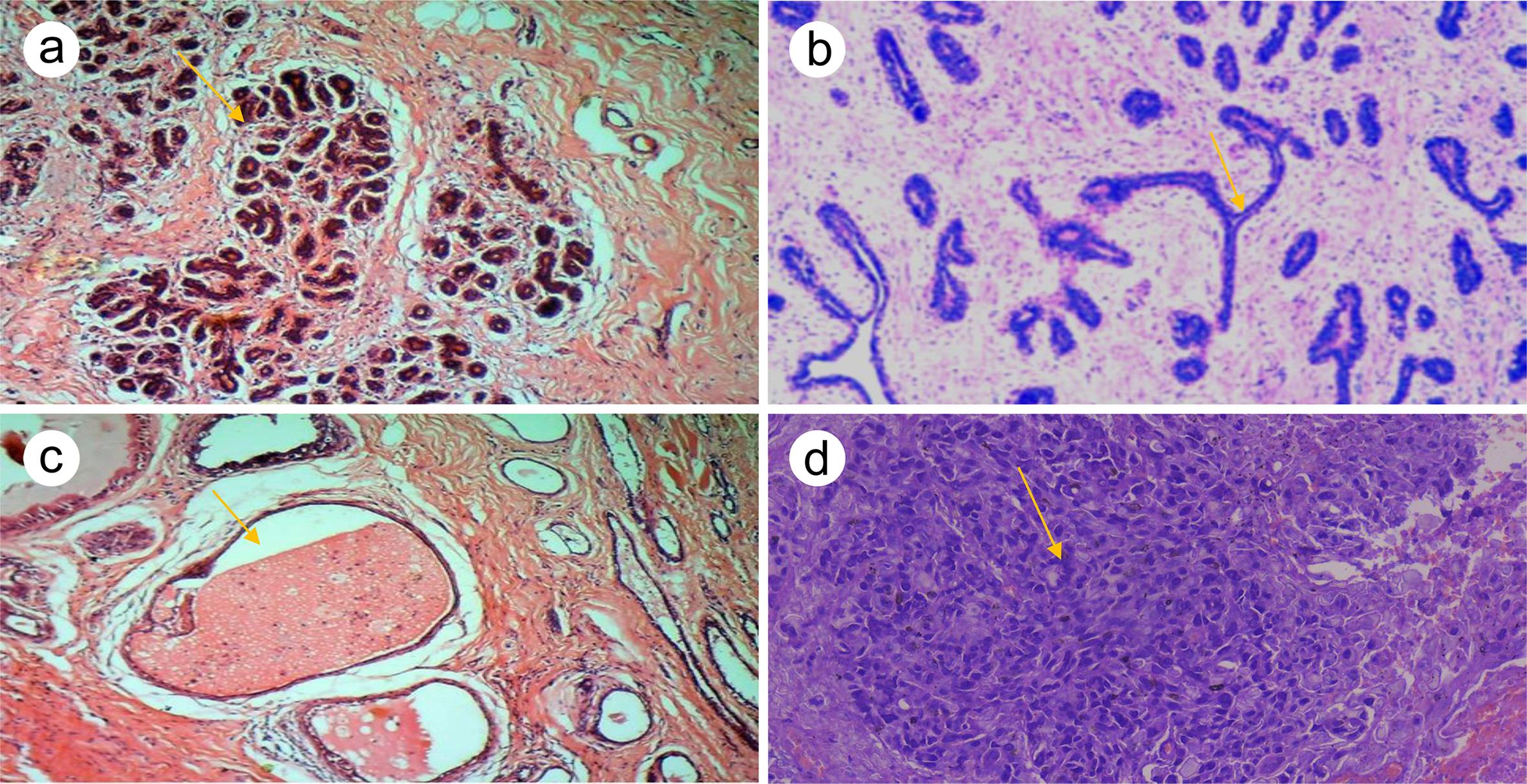 Hematoxylin and eosin-stained photomicrographs of (a) normal breast tissue section with lobules containing dark blue-stained acini nuclei (yellow arrow), separated by denser collagen fibers, compared with the stroma that separates the lobules ×400. (b) Breast lobules compressed into a slit-like shape (yellow arrow) due to excessive growth of the intervening stroma that separates the lobules (Fibroadenoma) ×400. (c) Cystic breast tissue with two large cysts (yellow arrow) filled with pink-staining amorphous material, lined by a single layer of epithelial cells ×400. (d) Invasive ductal carcinoma (Not Special Types).