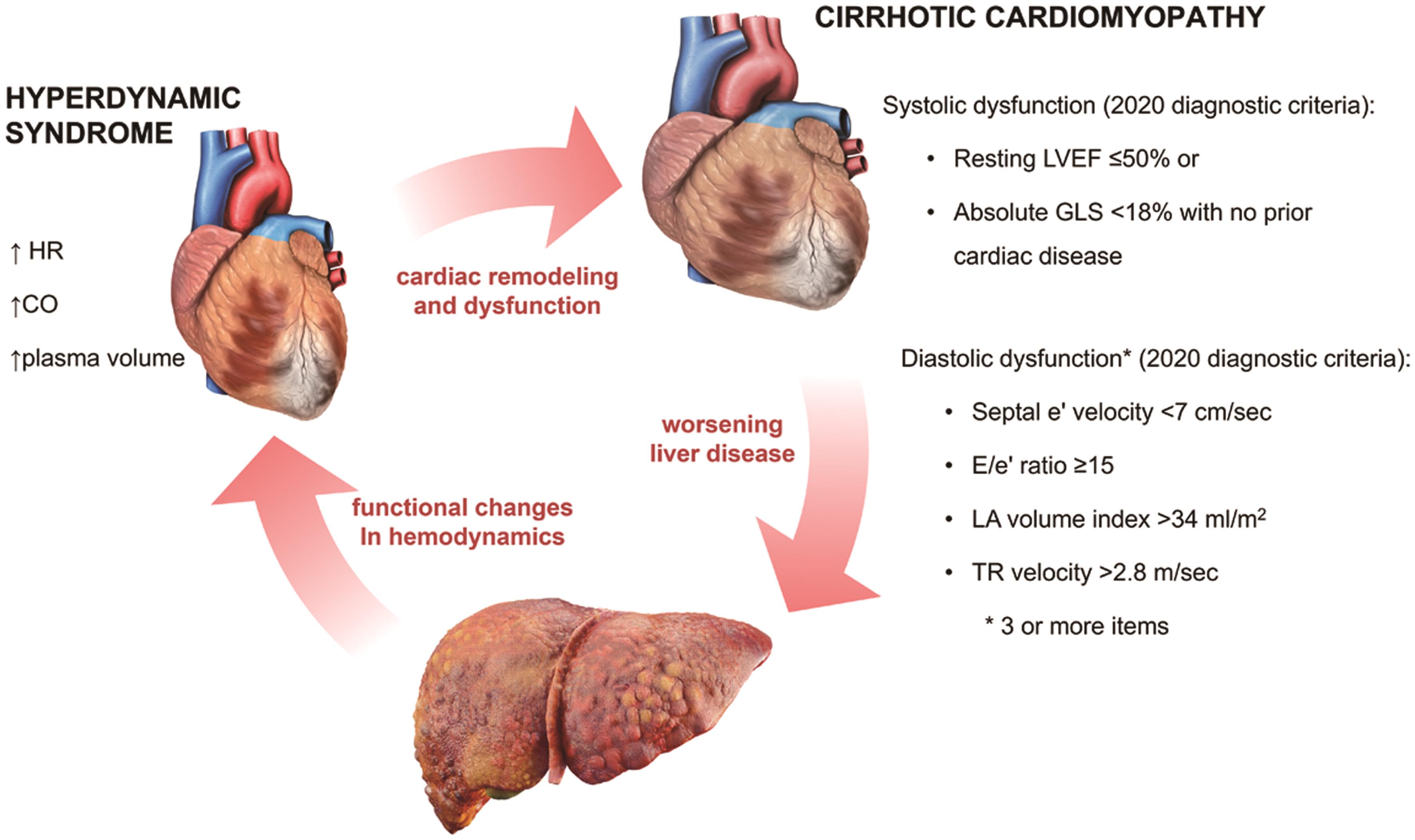 Evolution of cardiac dysfunction from hyperdynamic syndrome to cirrhotic cardiomyopathy.