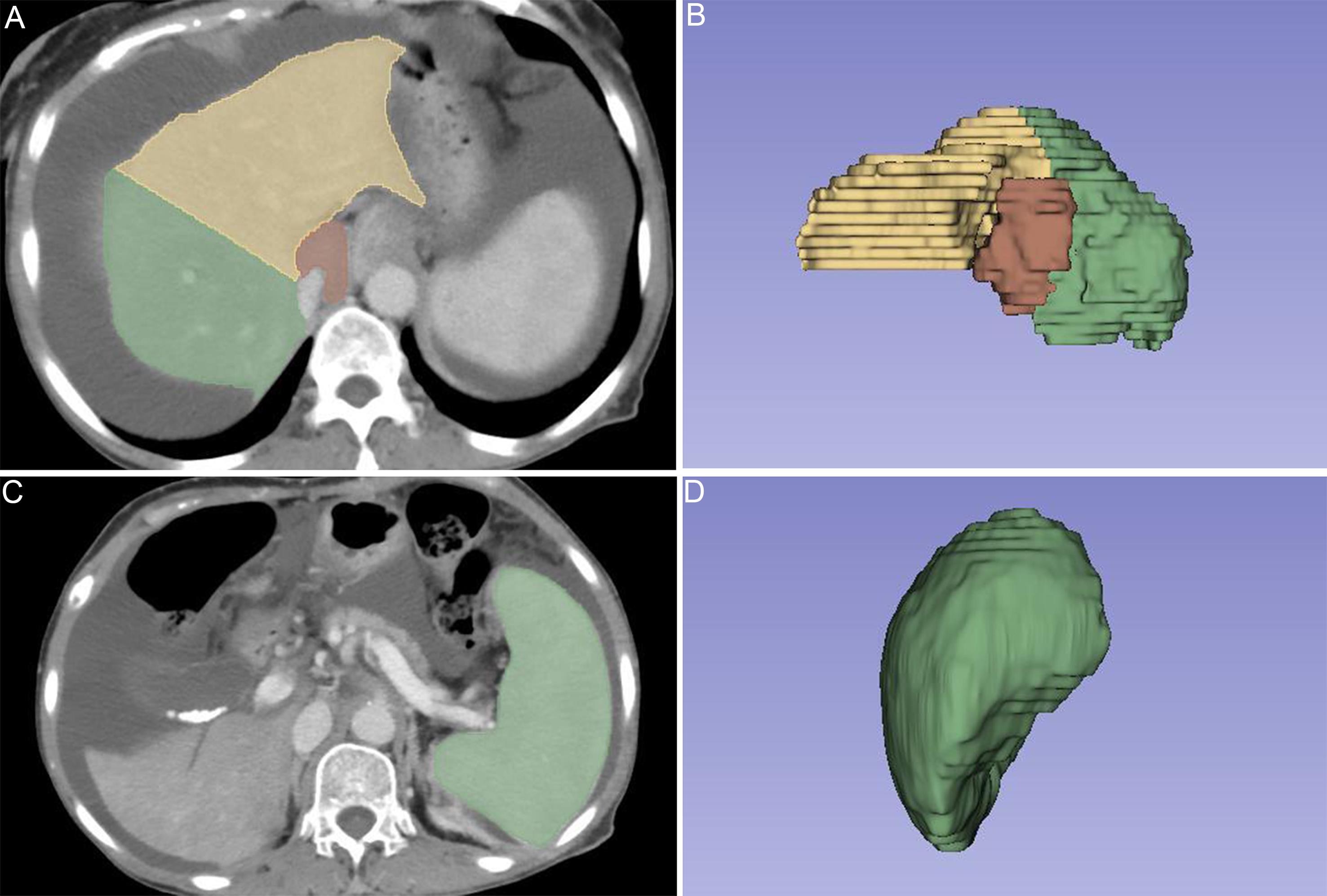 Hepatic and splenic segmentation using 3D Slicer software.