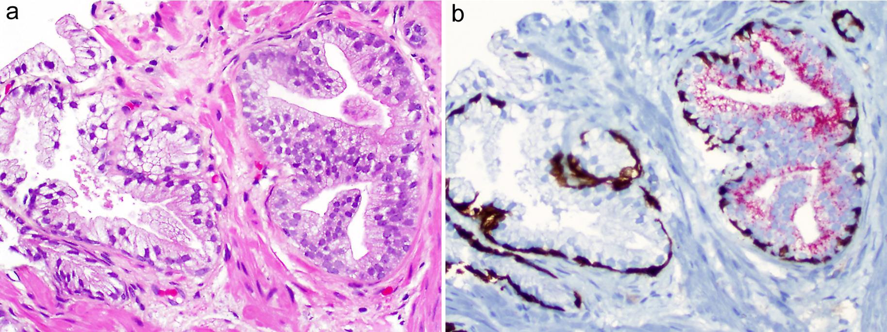 High-grade prostatic intraepithelial neoplasia (HGPIN) shows flat and papillary growth patterns, with the overlying epithelial cells having enlarged nuclei with prominent nucleoli.