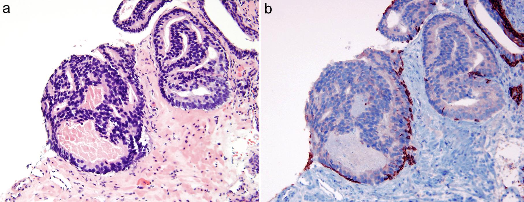 Atypical intraductal proliferation (AIP) shows atypical loose cribriform glands (a) (×200). On immunostain, AIP is positive for racemase and basal cell markers (CK903 and p63) (b) (×200).