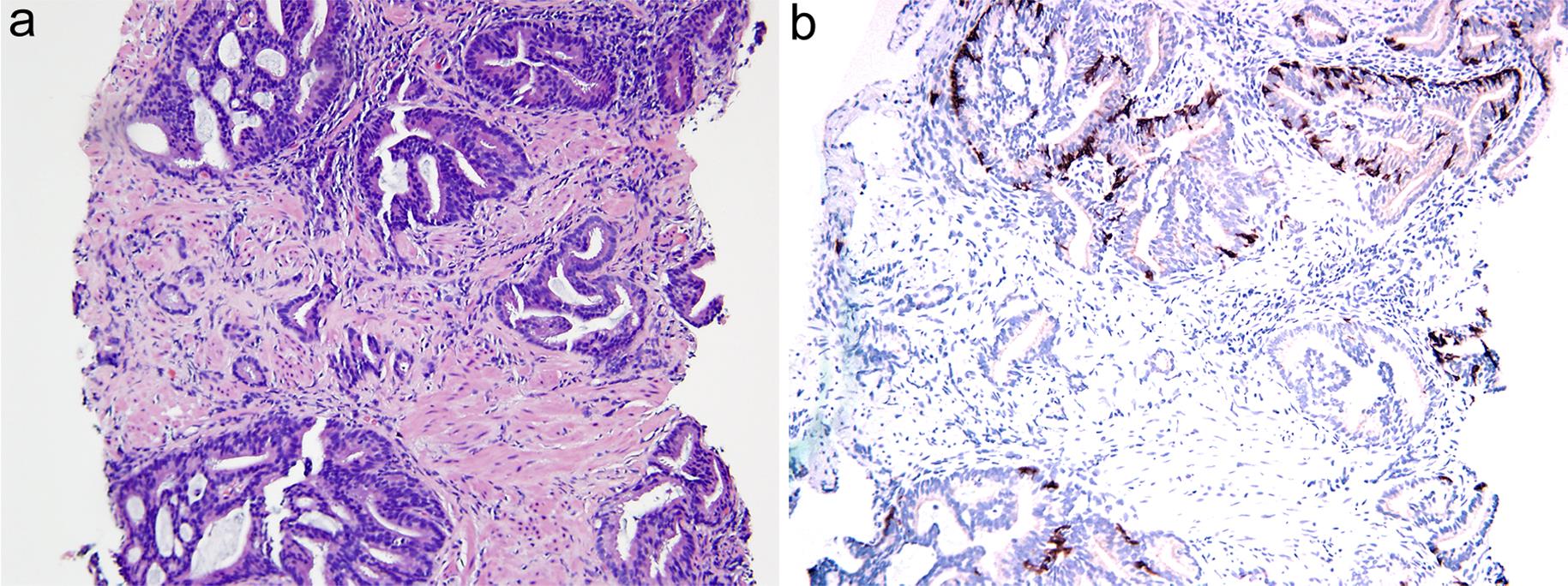 IDC coexists with acinar adenocarcinoma (a) (×100). On immunostain, IDC is positive for racemase and CK903 and p63, while acinar carcinoma is positive for racemase and negative for CK903 and p63 (b) (×100). Per the GUPS guidelines, the Gleason score is graded as 6 (3 + 3) with IDC, as IDC is not included in the Gleason score. Per the ISUP guidelines, the Gleason score is graded as 7 (4 + 3) with IDC, as IDC is included in the Gleason score.
