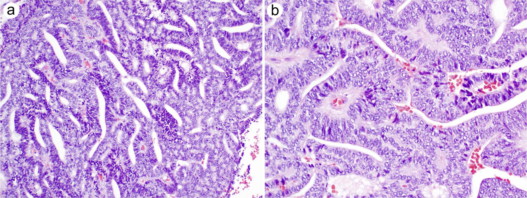 Ductal carcinoma exhibits cribriform and papillary growth patterns.
