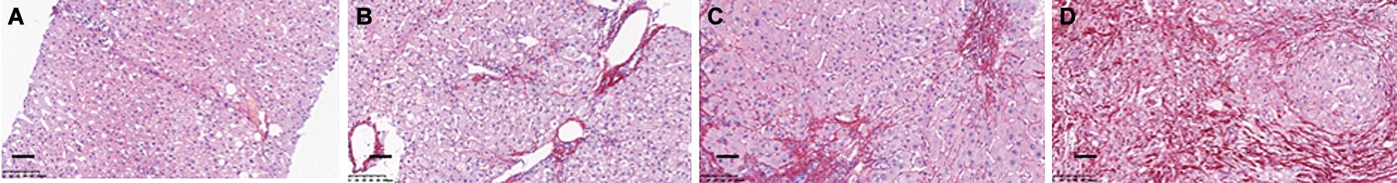 Comparison of Sirius Red staining with LSM values on CHB liver tissues.