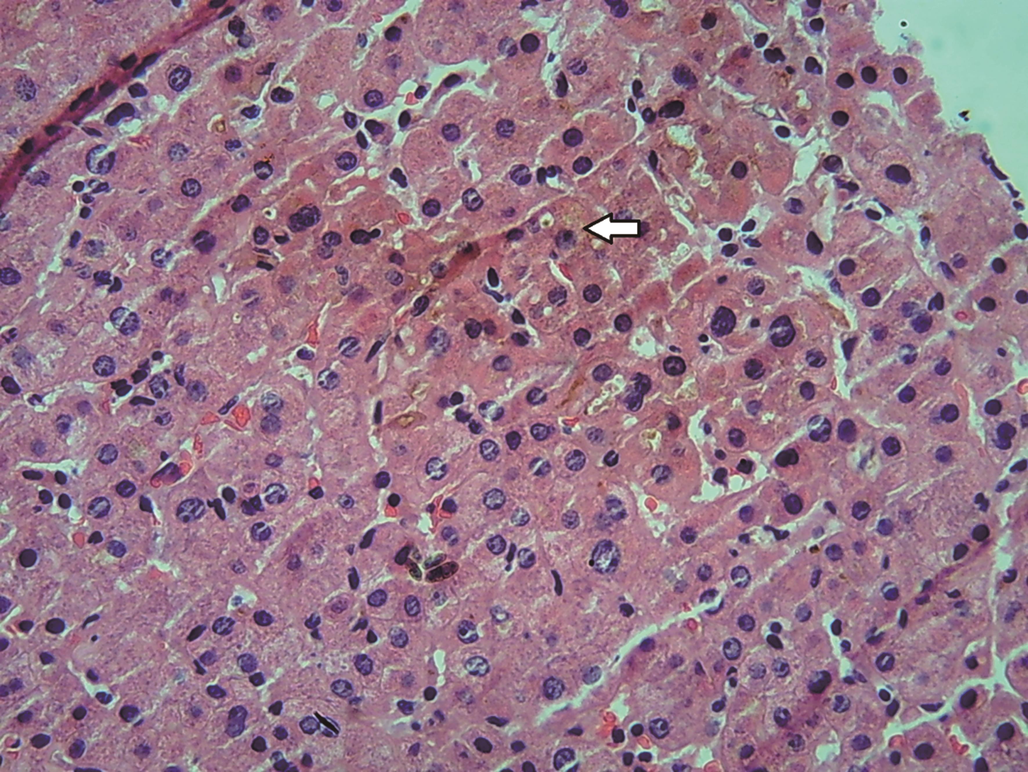 Liver biopsy with a high-power view of moderate hepatocellular cholestasis (white arrow) with bilirubinostasis.