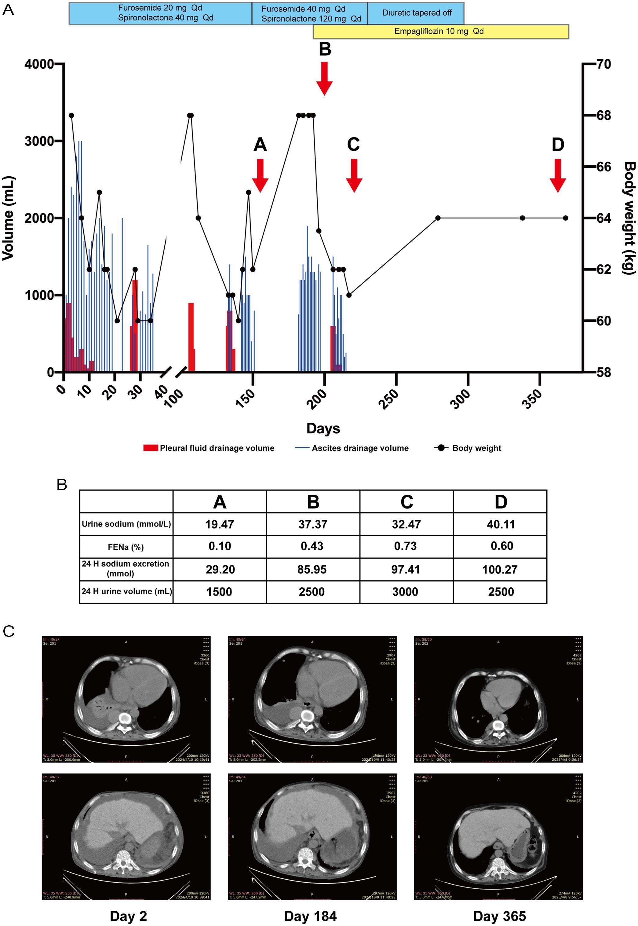 Changes in patient’s ascitic and pleural fluid drainage, urinary sodium excretion changes, and chest and abdominal computed tomography scans.