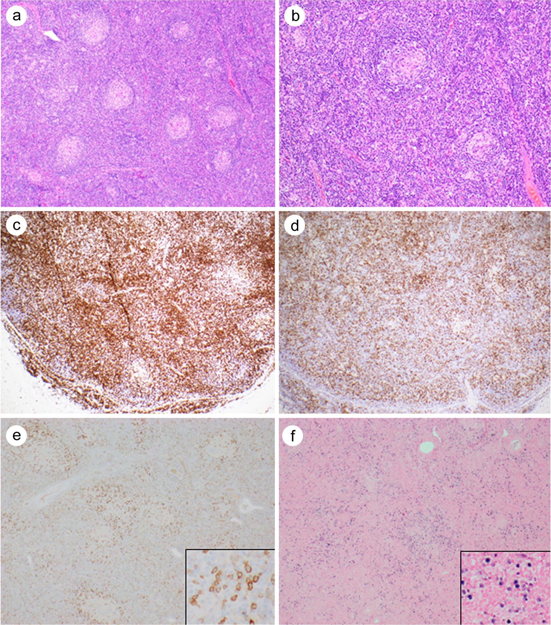 Nodal T follicular helper cell lymphoma, angioimmunoblastic T-cell lymphoma type, mimicking Castleman disease.