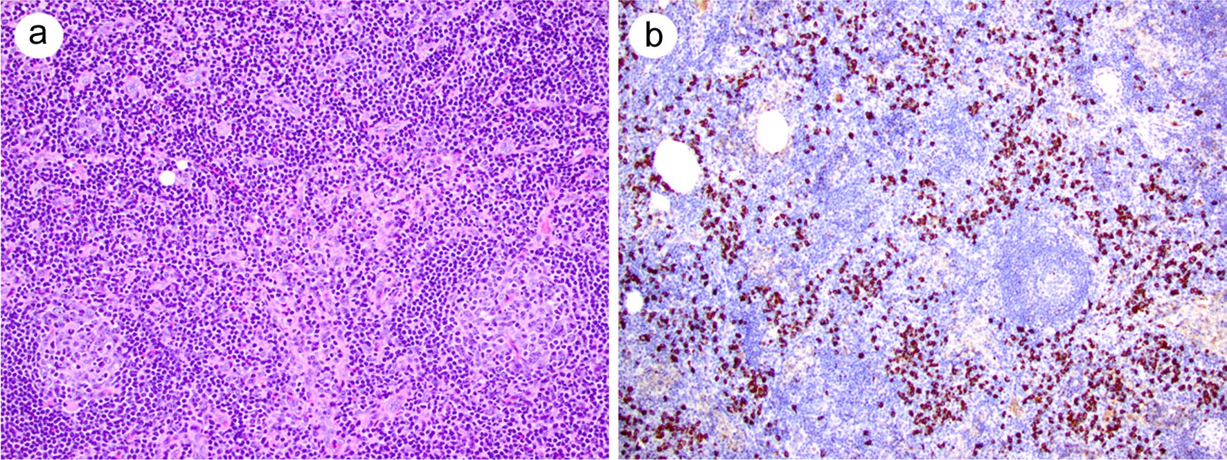 IgG4-related lymphadenopathy, mimicking Castleman disease.