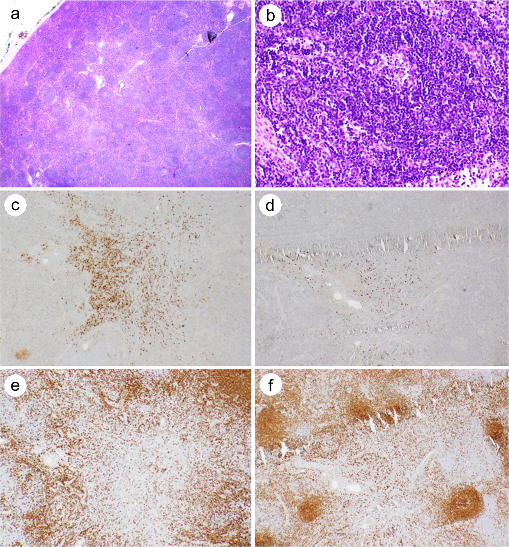 A case of Castleman disease with indolent B lymphoblast proliferation.